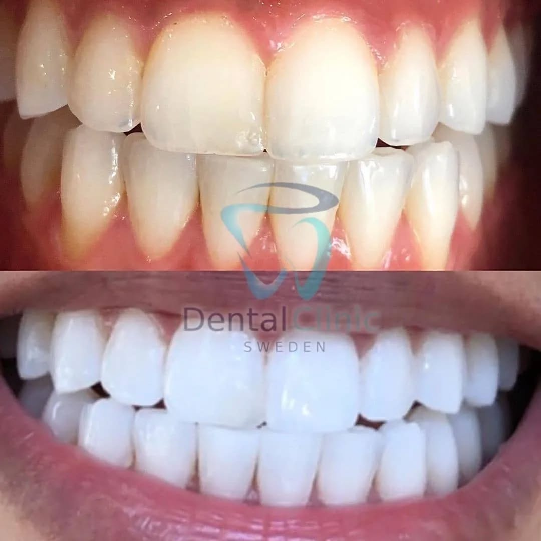 Klinik Tandblekning 
ERBJUDANDE 1490 KR (Ordinarie pris 4900 kr)
ONLINE TIDSBOKNING
www.DentalClinicSweden.org🔺️ BOKA FÖR 2 PERSONER & FÅ YTTLIGARE 200 KR RABATT!
 #tandblekningstockholm #TandblekningStockholm #stockholm #liljeholmen #KlinikTandblekning #TandblekningGöteborg #TandblekningUppsala #TandblekningUtbildning #TandblekningsUtbildning