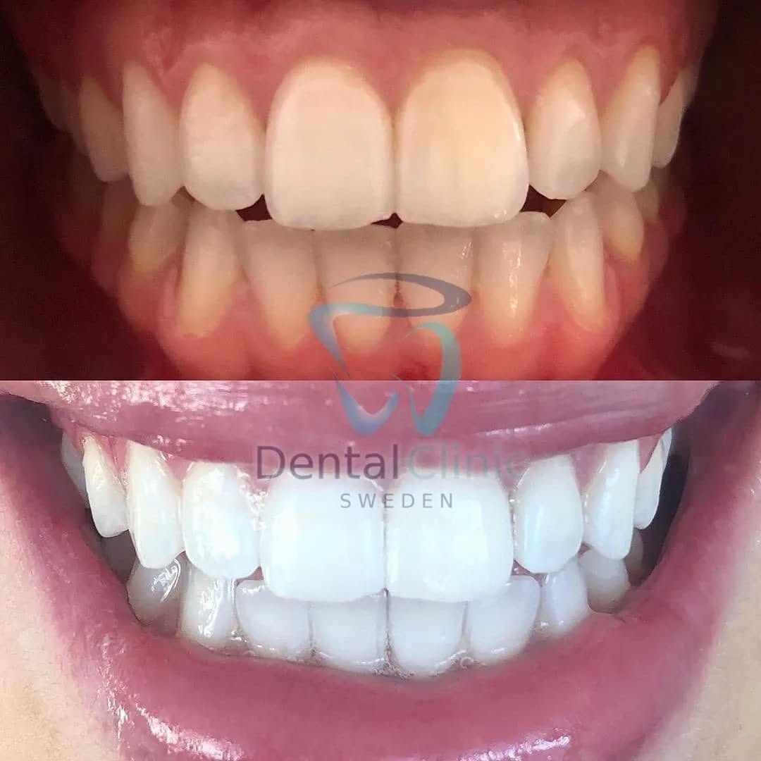 Klinik Tandblekning 
ERBJUDANDE 1490 KR (Ordinarie pris 4900 kr)
ONLINE TIDSBOKNING
www.DentalClinicSweden.org🔺️ BOKA FÖR 2 PERSONER & FÅ YTTLIGARE 200 KR RABATT!
 #tandblekningstockholm #TandblekningStockholm #stockholm #liljeholmen #KlinikTandblekning #TandblekningGöteborg #TandblekningUppsala #TandblekningUtbildning #TandblekningsUtbildning