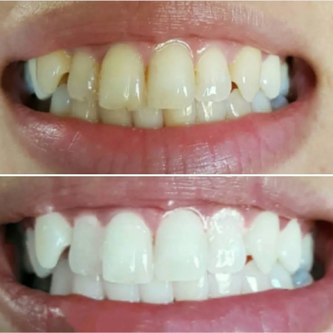 Klinik Tandblekning 
ERBJUDANDE 1490 KR (Ordinarie pris 4900 kr)
ONLINE TIDSBOKNING
www.DentalClinicSweden.org🔺️ BOKA FÖR 2 PERSONER & FÅ YTTLIGARE 200 KR RABATT!
 #tandblekningstockholm #TandblekningStockholm #stockholm #liljeholmen #KlinikTandblekning #TandblekningGöteborg #TandblekningUppsala #TandblekningUtbildning #TandblekningsUtbildning