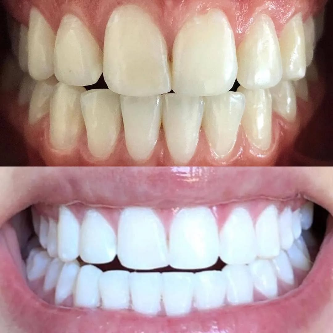 Klinik Tandblekning 
ERBJUDANDE 1490 KR (Ordinarie pris 4900 kr)
ONLINE TIDSBOKNING
www.DentalClinicSweden.org🔺️ BOKA FÖR 2 PERSONER & FÅ YTTLIGARE 200 KR RABATT!
 #tandblekningstockholm #TandblekningStockholm #stockholm #liljeholmen #KlinikTandblekning #TandblekningGöteborg #TandblekningUppsala #TandblekningUtbildning #fillers #fillersstockholm #fillersgöteborg #fillersmalmö #TandblekningsUtbildning