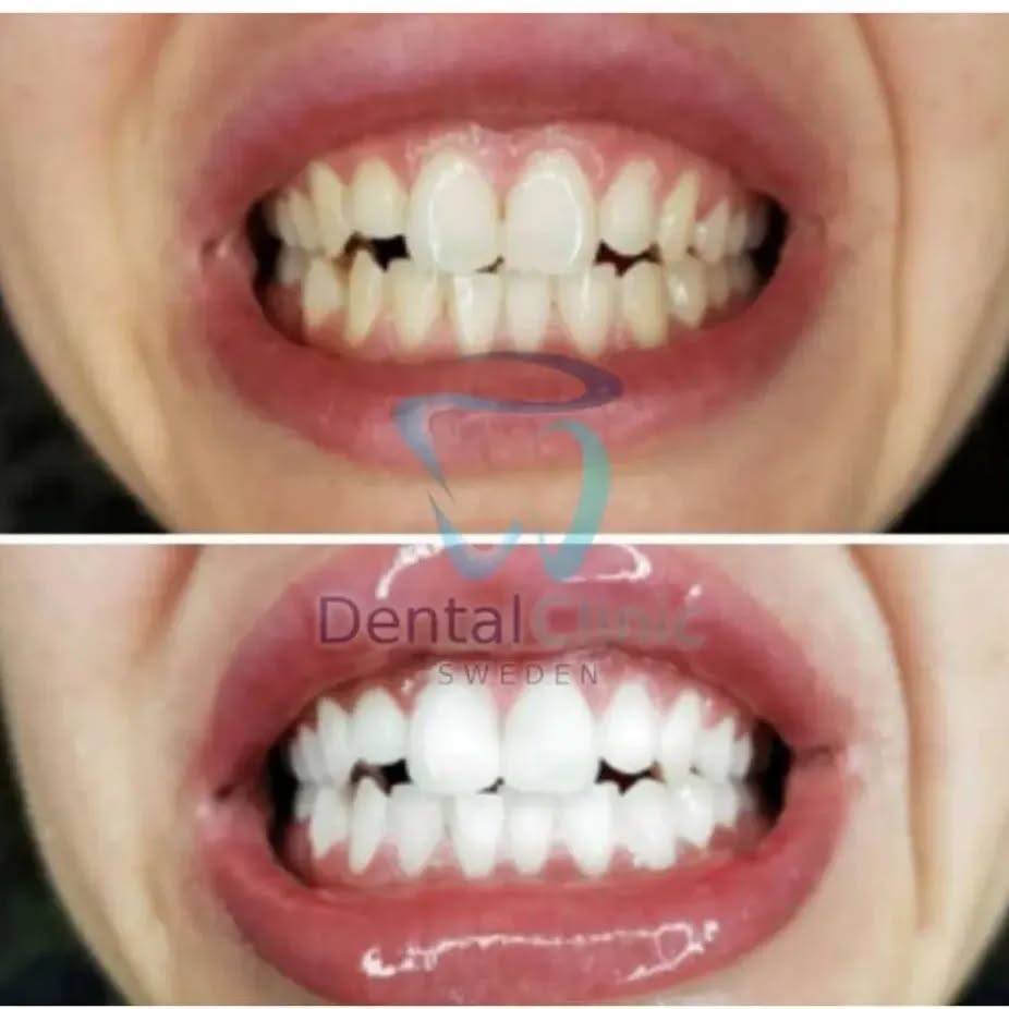 Klinik Tandblekning 
ERBJUDANDE 1490 KR (Ordinarie pris 4900 kr)
ONLINE TIDSBOKNING
www.DentalClinicSweden.org🔺️ BOKA FÖR 2 PERSONER & FÅ YTTLIGARE 200 KR RABATT!
 #tandblekningstockholm #TandblekningStockholm #stockholm #liljeholmen #KlinikTandblekning #TandblekningGöteborg #TandblekningUppsala #TandblekningUtbildning #fillers #fillersstockholm #fillersgöteborg #fillersmalmö #TandblekningsUtbildning