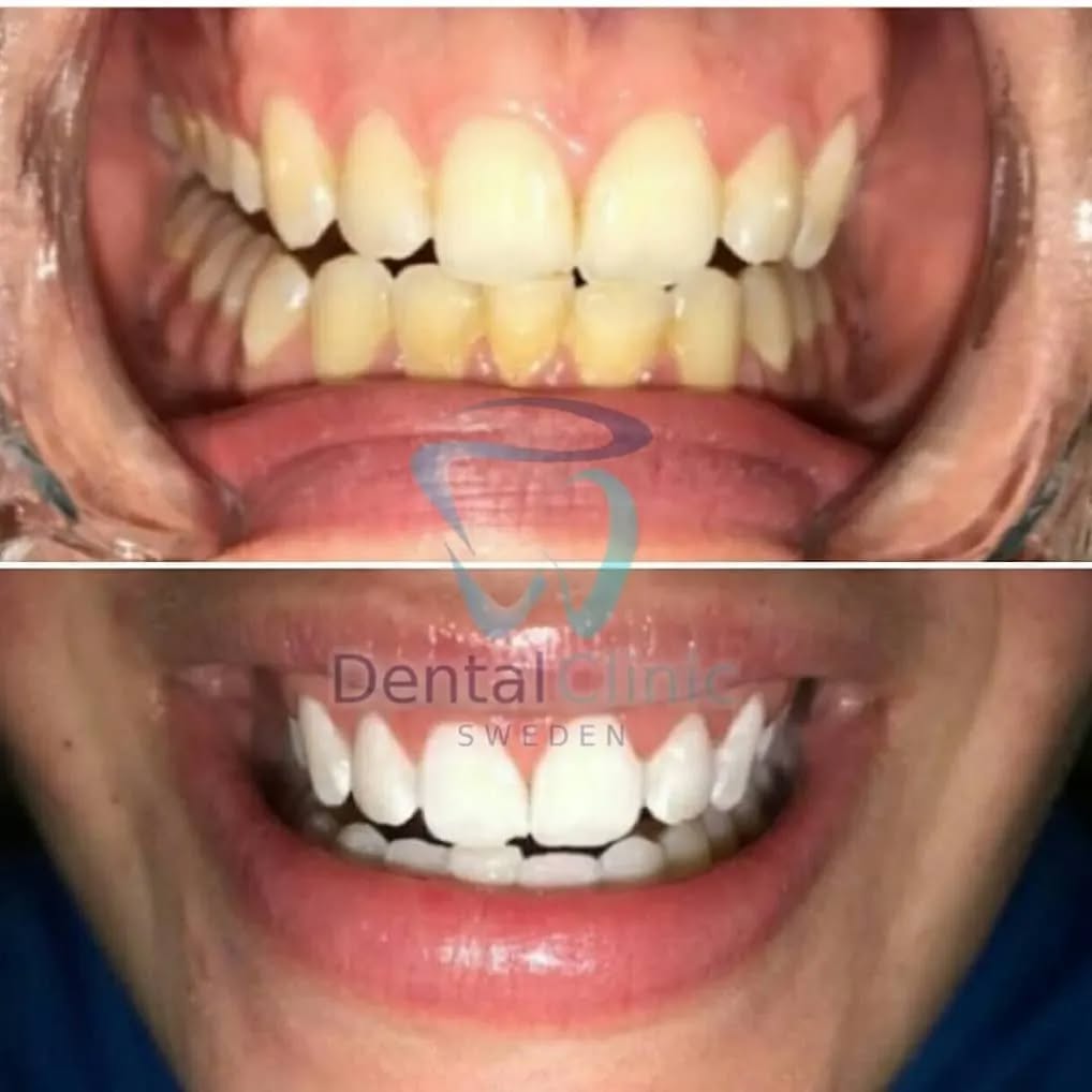 Klinik Tandblekning 
ERBJUDANDE 1490 KR (Ordinarie pris 4900 kr)
ONLINE TIDSBOKNING
www.DentalClinicSweden.org🔺️ BOKA FÖR 2 PERSONER & FÅ YTTLIGARE 200 KR RABATT!
 #tandblekningstockholm #TandblekningStockholm #stockholm #liljeholmen #KlinikTandblekning #TandblekningGöteborg #TandblekningUppsala #TandblekningUtbildning #fillers #fillersstockholm #fillersgöteborg #fillersmalmö #TandblekningsUtbildning