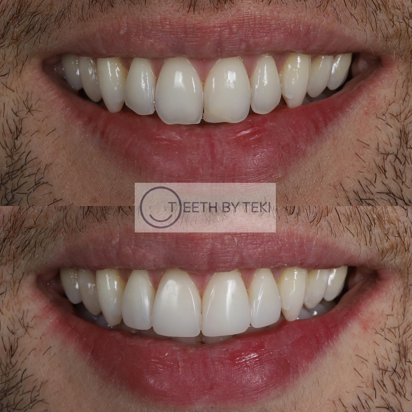Why I love composite bonding ⚪️💙
.
.
There’s around 90 minutes between taking these photos
.
.
Safe, simple and won’t damage your teeth 🫶🏽
.
.
#teethbyteki #compositebonding #compositeveneers #dentist
