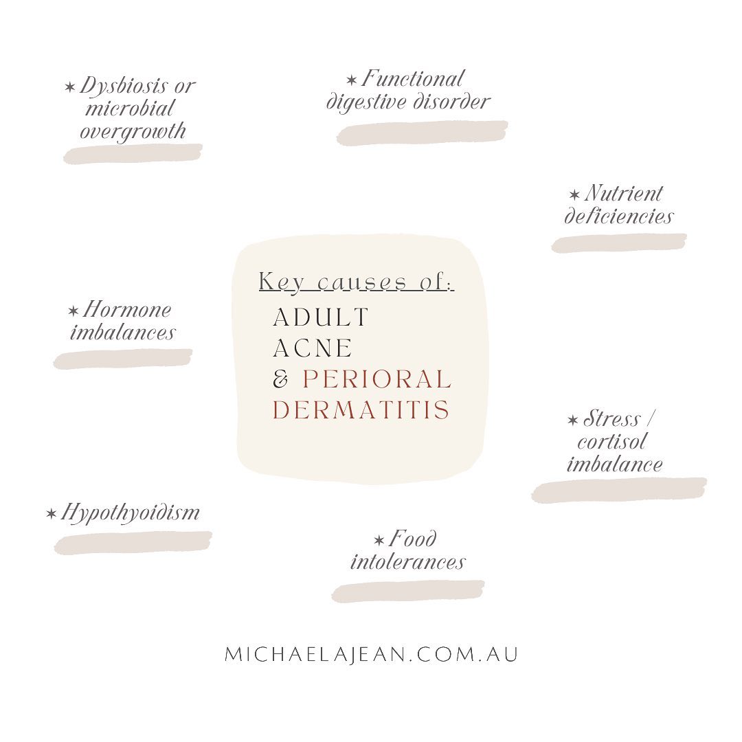 It is not uncommon that my clients will recall that it was when they were treating their breakouts / acne, they ended up with a red sore bumpy sort-of pimply rash around their chin / nose that just WONT go away.
The name of the beast: perioral dermatitis. Angry, pissed-off skin (the worst!!! 🙈😩)
This is because the nature of common approaches to acne treatment is harsh and does not respect the delicate skin mantle-barrier. And this lads, is the army of bugs + yummy protective lipids that we absolutely NEED to avoid skin inflammation (AKA the nature of literally every skin disorder!!!!).
Having said this —> please know that it is not just because you treated your acne that you ended up with dermatitis. The origin of both acne + dermatitis are very much in common + certainly related to systemic imbalances / nutrient deficiencies that linger far below the epidermal surface; therefore we see these chemicals not as causes but as a “perioral dermatitis trigger”
Some underlying causes of acne + perioral dermatitis
✶ Dysbiosis (your gut bugs may be over/under-grown or out of balance) + gut-driven inflammation
✶ Functional digestive disorder + gut-driven inflammation
✶ Candidiasis
✶ Hormonal imbalances - e.g. oestrogen dominance/deficiency
✶ Hypothyroidism
✶ Nutrient deficiencies - e.g. Vitamin D, Iodine, Zinc, EFA’s, protein
✶ Histamine intolerance / mast-cell activation syndrome
✶ Food intolerances - e.g. cow’s dairy
✶ Stress - anxiety + cortisol imbalances are very commonly involved and must be addressed
And again - PLEASE be careful with your skincare. Keep things simple. You may do well to work with a facialist to curate this, introducing actives as your delicate skin heals. The last thing we want is more trauma introduced to the skin. Oils may also not be supportive to your skin right now. Whilst oils are incredibly nourishing, if microbial overgrowths are involved, particularly fungal e.g. candida, these might be feeding these microbes perpetuating your condition ♡.