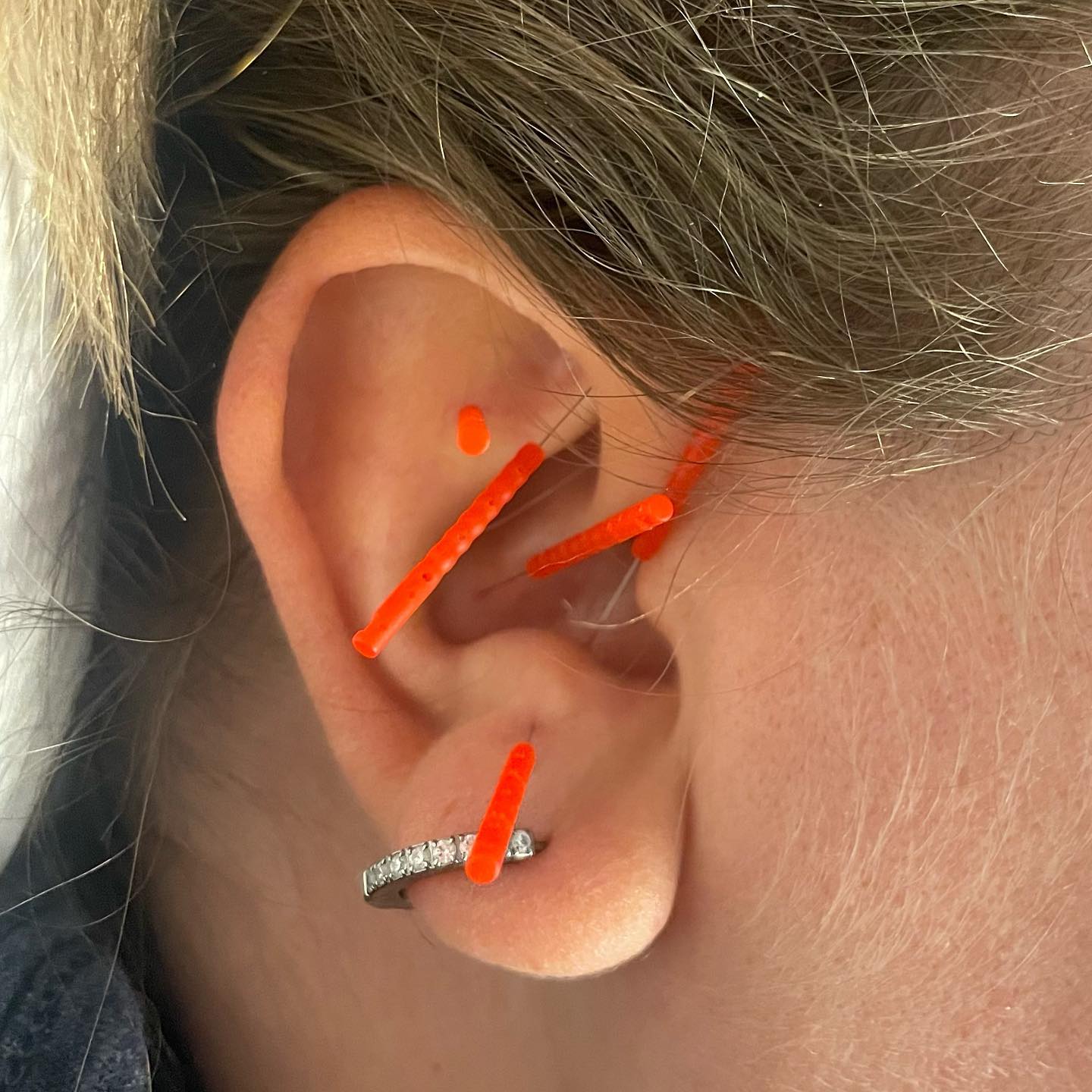 Auricular acupuncture before an egg retrieval to decrease pain, calm the mind and harmonize the body. #acupuncture #earacupuncture #fertility #eggretrieval #cnyfertility #ivf