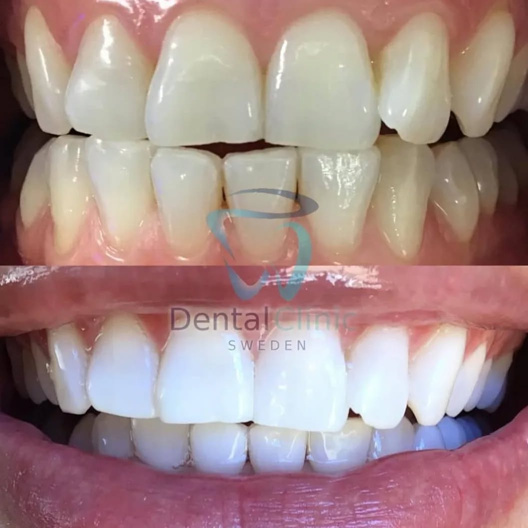 Klinik Tandblekning 
ERBJUDANDE 995 KR När ni bokar för 2 personer (DUO BEHANDLING)(Ordinarie pris 4900 kr) 
ONLINE TIDSBOKNING
www.DentalClinicSweden.org🔺️
 #tandblekningstockholm #TandblekningStockholm #stockholm #liljeholmen #KlinikTandblekning #TandblekningGöteborg #TandblekningUppsala #TandblekningUtbildning #fillers #fillersstockholm #fillersgöteborg #fillersmalmö #TandblekningsUtbildning