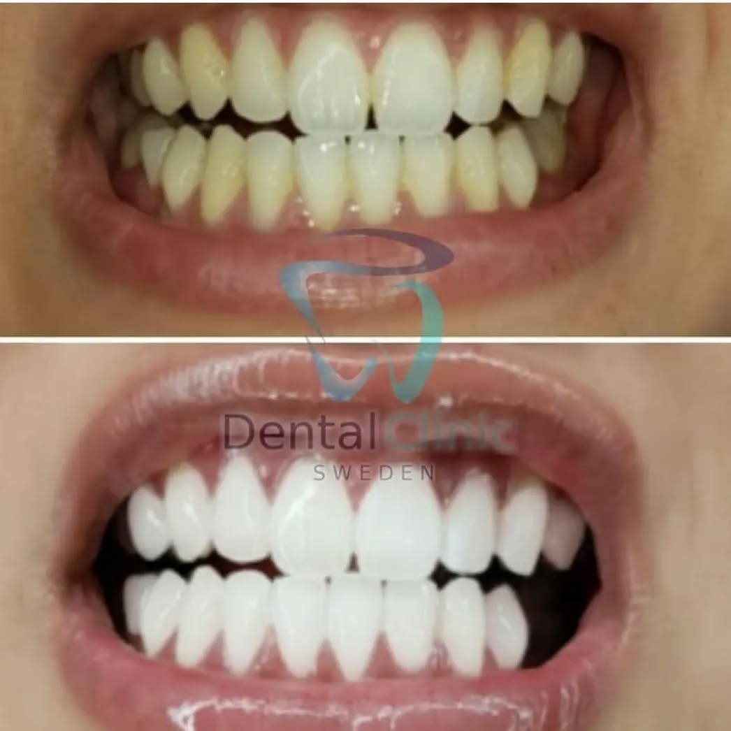 ERBJUDANDE 995 KR När ni bokar för 2 personer. Priset gäller per person (DUO BEHANDLING)(Ordinarie pris 4900 kr) 
ONLINE TIDSBOKNING
www.DentalClinicSweden.org🔺️
 #tandblekningstockholm #TandblekningStockholm #stockholm #liljeholmen #KlinikTandblekning #TandblekningGöteborg #TandblekningUppsala #TandblekningUtbildning #fillers #fillersstockholm #fillersgöteborg #fillersmalmö #TandblekningsUtbildning