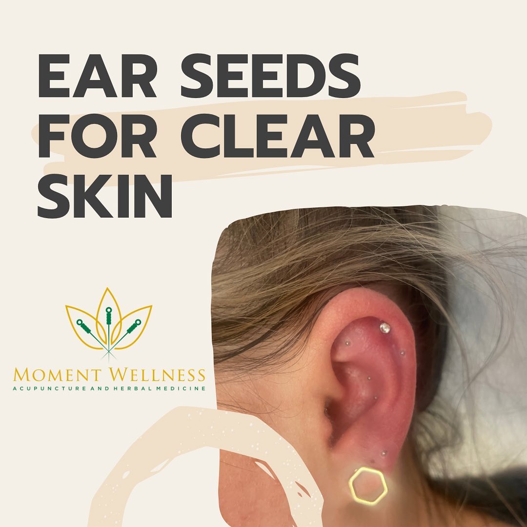 Hormonal acne getting you down?? IVF stimulation medications can reek havoc on the skin. Ear seeds are a natural and pain-free option to support clear skin without interfering with IVF protocols. #auricularacupuncture #earseeds #IVF #acne #hormonalacne #clearskin #skindisorders