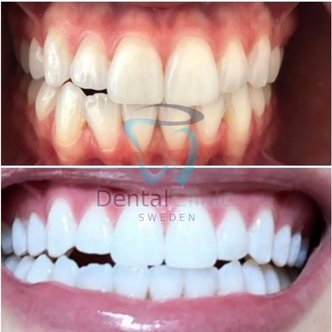 ERBJUDANDE 995 KR När ni bokar för 2 personer. Priset gäller per person (DUO BEHANDLING)(Ordinarie pris 4900 kr) 
ONLINE TIDSBOKNING
www.DentalClinicSweden.org🔺️
 #tandblekningstockholm #TandblekningStockholm #stockholm #liljeholmen #KlinikTandblekning #TandblekningGöteborg #TandblekningUppsala #TandblekningUtbildning #fillers #fillersstockholm #fillersgöteborg #fillersmalmö #TandblekningsUtbildning