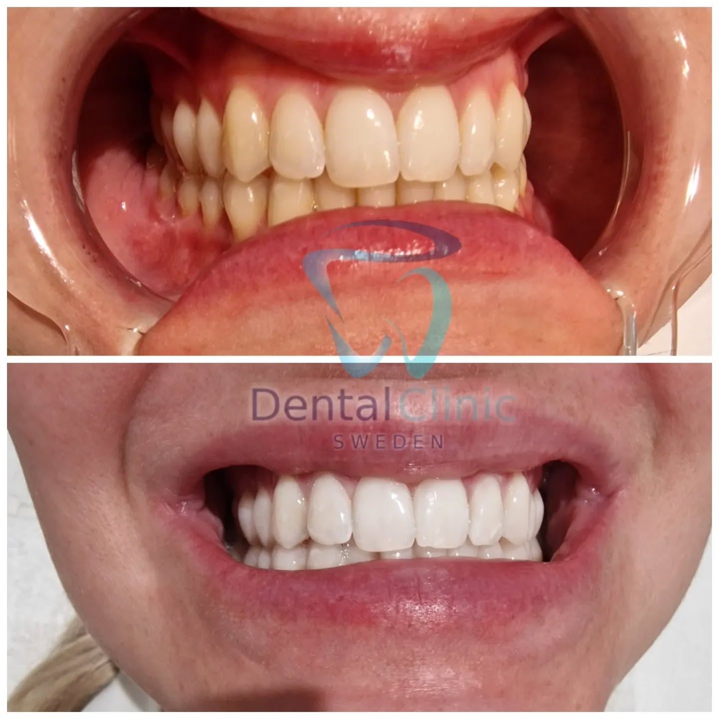 Klinik Tandblekning 
ERBJUDANDE 1490 KR (Ordinarie pris 4900 kr)
ONLINE TIDSBOKNING
www.DentalClinicSweden.org🔺️ BOKA FÖR 2 PERSONER & FÅ YTTLIGARE 200 KR RABATT!
 #tandblekningstockholm #TandblekningStockholm #stockholm #liljeholmen #KlinikTandblekning #TandblekningGöteborg #TandblekningUppsala #TandblekningUtbildning #fillers #fillersstockholm #fillersgöteborg #fillersmalmö #TandblekningsUtbildning