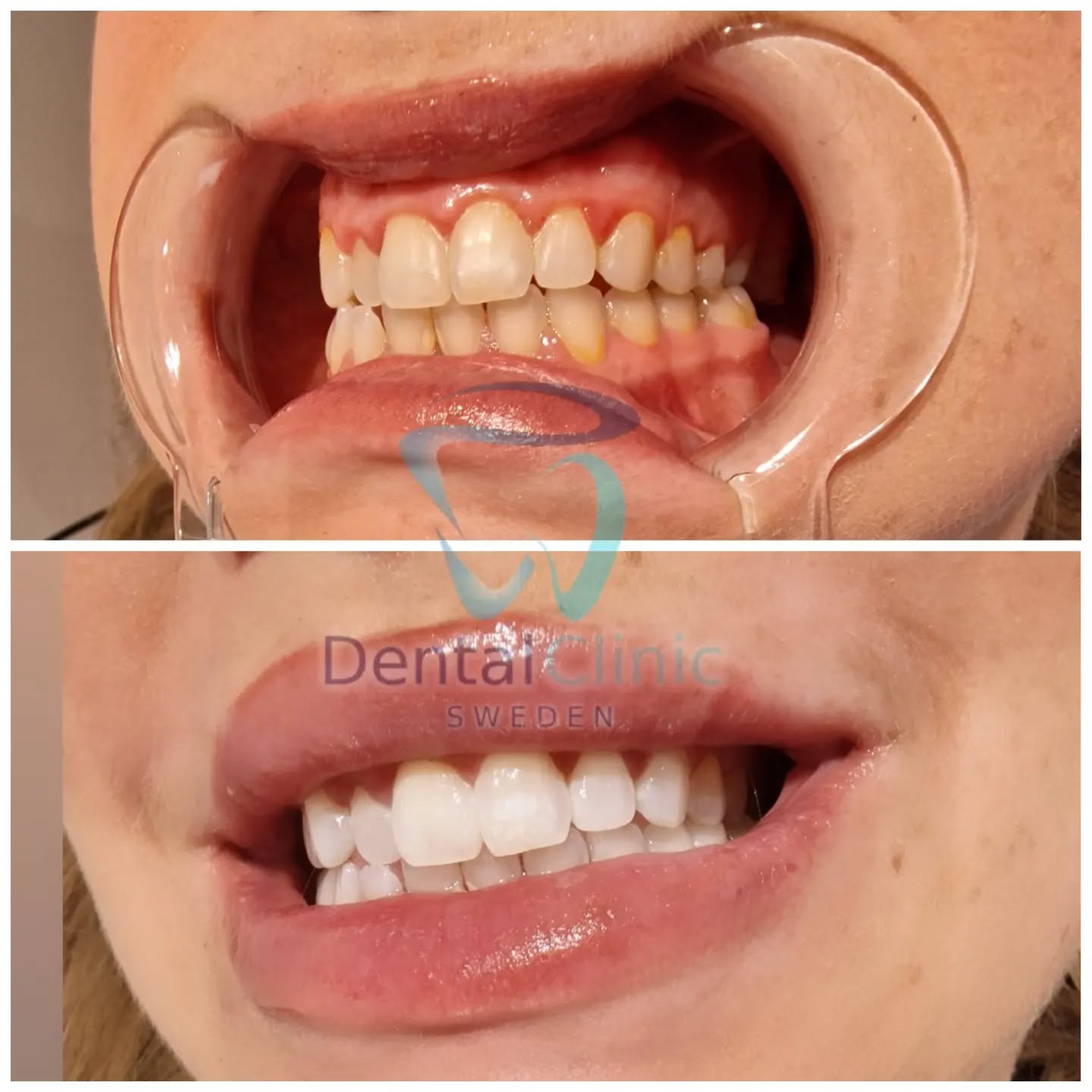 Klinik Tandblekning 
ERBJUDANDE 1490 KR (Ordinarie pris 4900 kr)
ONLINE TIDSBOKNING
www.DentalClinicSweden.org🔺️ BOKA FÖR 2 PERSONER & FÅ YTTLIGARE 200 KR RABATT!
 #tandblekningstockholm #TandblekningStockholm #stockholm #liljeholmen #KlinikTandblekning #TandblekningGöteborg #TandblekningUppsala #TandblekningUtbildning #fillers #fillersstockholm #fillersgöteborg #fillersmalmö #TandblekningsUtbildning