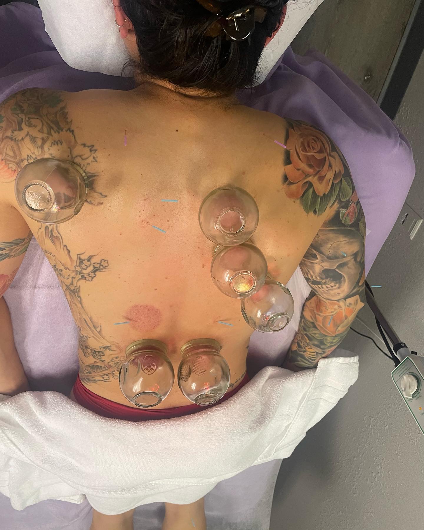 Cupping and Acupuncture for muscle balance and tension release. Swipe to see the addition of red light to warm, nourish and increase blood flow to speed healing. #acupuncture #cupping #firecupping #redlight #TDP #shoulderpain #backpain #balance