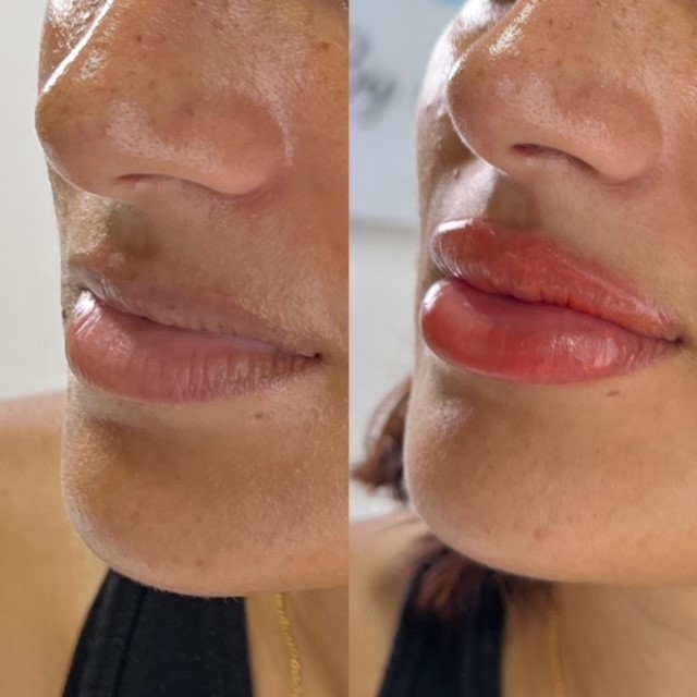 Semi-Permanent Lip Blush
Lip Blush is a Semi-Permanent treatment that enhances the colour and volume of your lips, making them look fuller whilst adding more definition around the border.
Lip colour blush tinting will heal 50% lighter to a soft blush of colour, still defined at the edges with a sparkling of colour, all you’ll need is a lip balm and you’re ready to go.
This treatment is also great for covering up scars and improving the shape of the lips.
(You will need further treatments for a lipstick effect)
If you’ve been thinking about Permanent Makeup for a while, then why not message / call today via 0771 429 4814 / WhatsApp or by filling in the form www.ByJools.co.uk to book your “FREE” no obligation consultation at my private studio in Marlow.
Clients Testimonial:
“I can't tell you how much more confident I feel, I wouldn't consider going anywhere else for treatments.”
-
-
-
-
#marlow #windsor #wooburngreen #cookham #henley #maidenhead #bourneend #highwycombe #makeup #permanentmakeup #semipermanentmakeup #beauty #Eyeliner #beachready #summer #Eyebrows #permanentmakeupbyjools #marlowmums #mums #beauty #mentalhealth #loveyourself #lips #lipblush #moretimeforyou #buckinghamshire #Berkshire #confidence