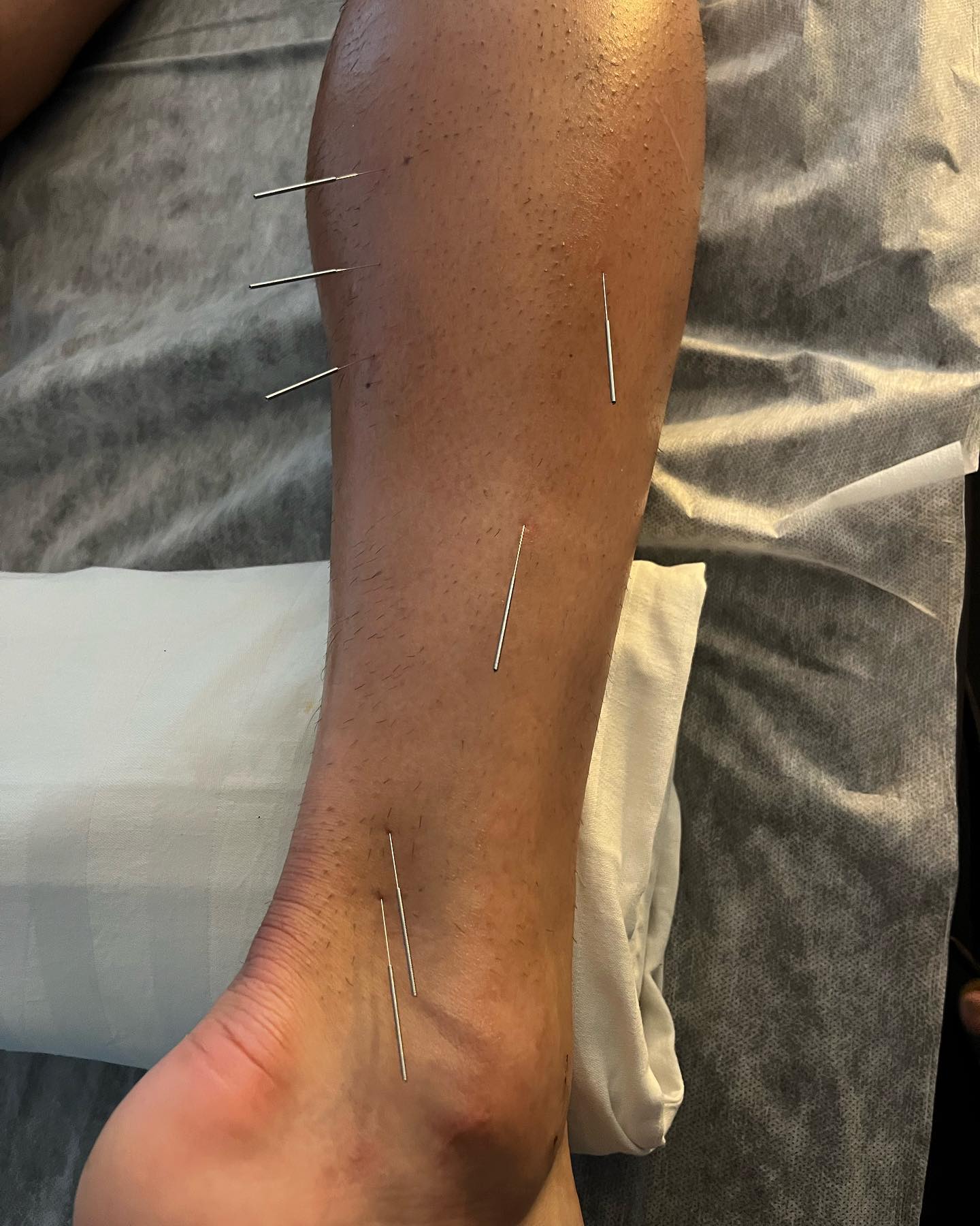 💢Akupunktūra su elektros stimuliacija, po Pro futbolo sukelto M. Soleus raumens plyšimo ir šlaunies dvigalvio raumens atpalaidavimas. Stimuliacijos metu pridėta infraraudonoji šviesos terapija, kuri veikia giliai į pažeistą paskatinant ląstelių dauginimasi bei gyjimą, taip pat pridėta vakuuminės taurės manipululiacija pagerinti kraujotaką pažeistuose raumenyse.
Akupunktūra su elektros stimuliacija pagreitina traumos gyjimą, mažina skausmą, gerina kraujotaką, mažina pažeisto audinio “scar tissue” susidarimą.♨️