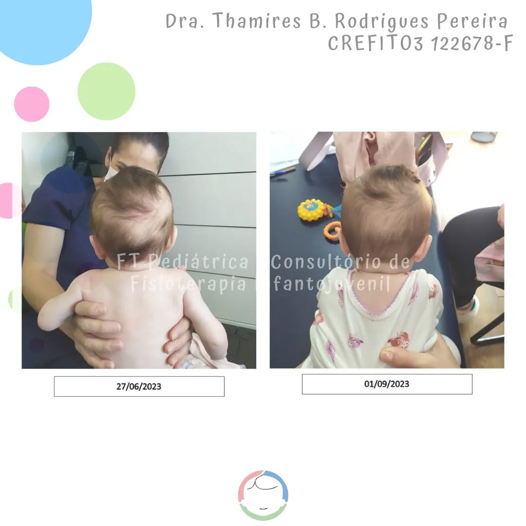 Já que hoje é quinta, lá vai o TBT de 5 pacientes diferentes que passaram ou ainda passam por aqui!
Tratamento de Torcicolo e Assimetria
Método de Setti
@carolinadesetti