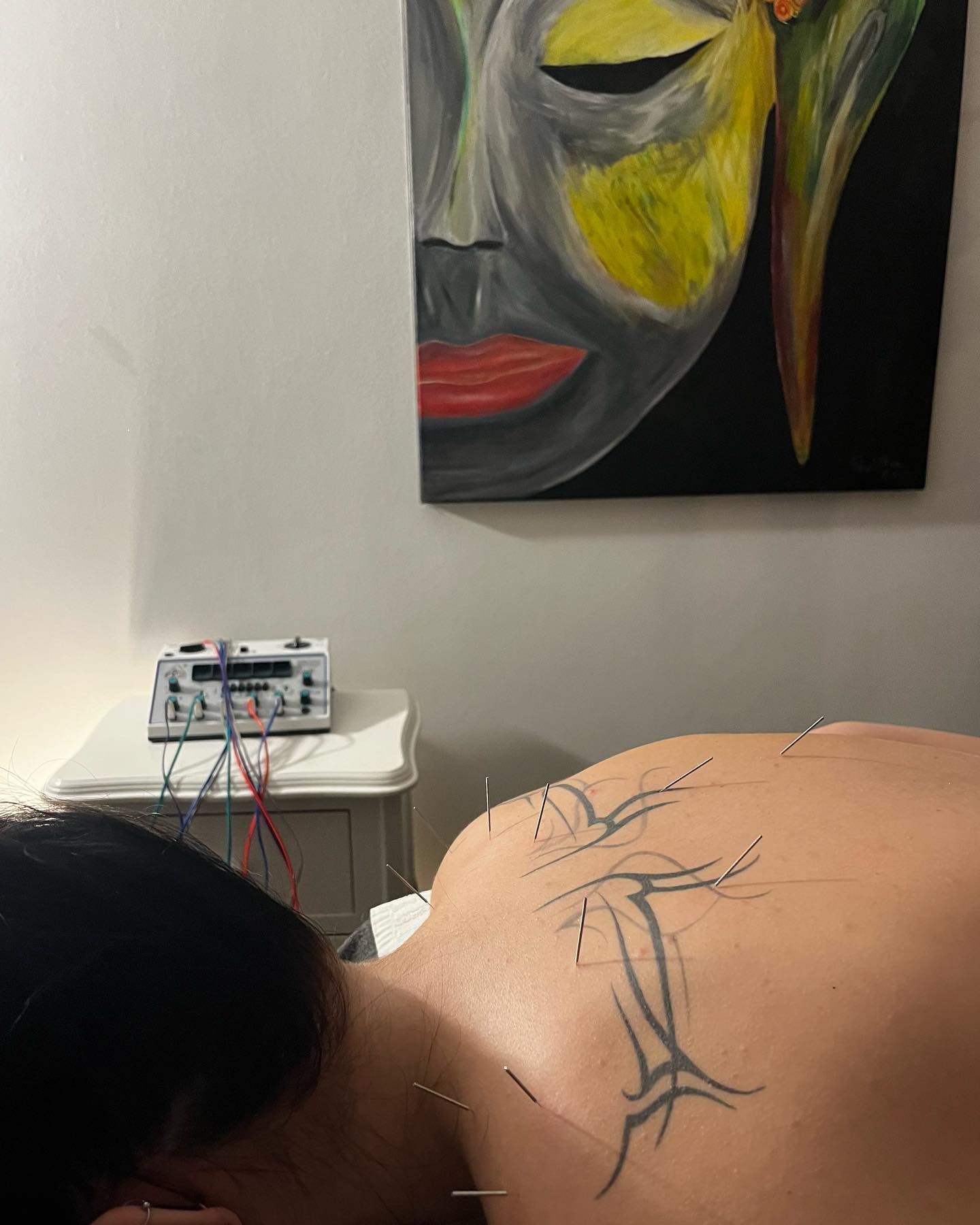 ❤️🔥Ugnė atvyko su įtampa pečių juostoje, kurią galimai sukėlė sėdimas darbas ir nepatogi laikysena.Jai buvo atliekama akupunktūra su elektros stimuliacija, giluminis masažas, atpalaidavimas vakuuminėmis taurėmis.
Nuotraukoje matomos adatėlės vaizduoją adatėlių išsidėstimą pečių ir kaklo raumenų atpalaidavimui😌