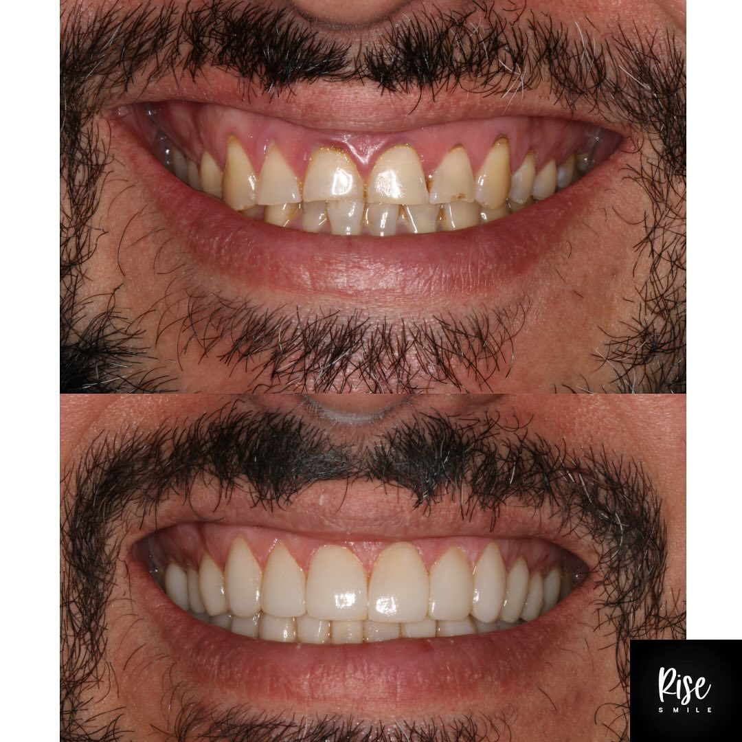 Caso complejo de Rehabilitación + Aumento de Dimensión Vertical realizado completamente con Resina Compuesta 🙌
Desliza las fotos para ver esta transformación impactante de nuestro paciente el cual acude a nosotros con gran desgaste, reflujo gastroesofágico, molestias y sensibilidad. Con un enfoque rehabilitador, estabilizando la oclusión y los tejidos gingivales, se reconstruyen todos los dientes recuperando la altura perdida por el desgaste mediante el uso de resina compuesta y máxima conservación de la estructura dentaria, logrando un resultado estético y funcional. Te invitamos a ver el caso!!! 🤍