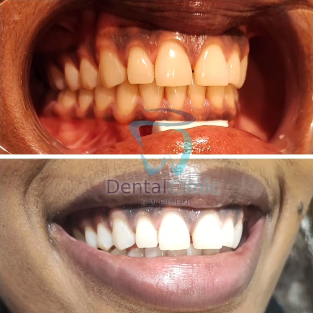 Klinik Tandblekning 
ERBJUDANDE 1490 KR (Ordinarie pris 4900 kr)
ONLINE TIDSBOKNING
www.DentalClinicSweden.org🔺️
 #tandblekningstockholm #TandblekningStockholm #stockholm #liljeholmen #KlinikTandblekning #TandblekningGöteborg #TandblekningUppsala #TandblekningUtbildning #fillers #fillersstockholm #fillersgöteborg #fillersmalmö #TandblekningsUtbildning #fillersstockholm #russianlipsstockholm