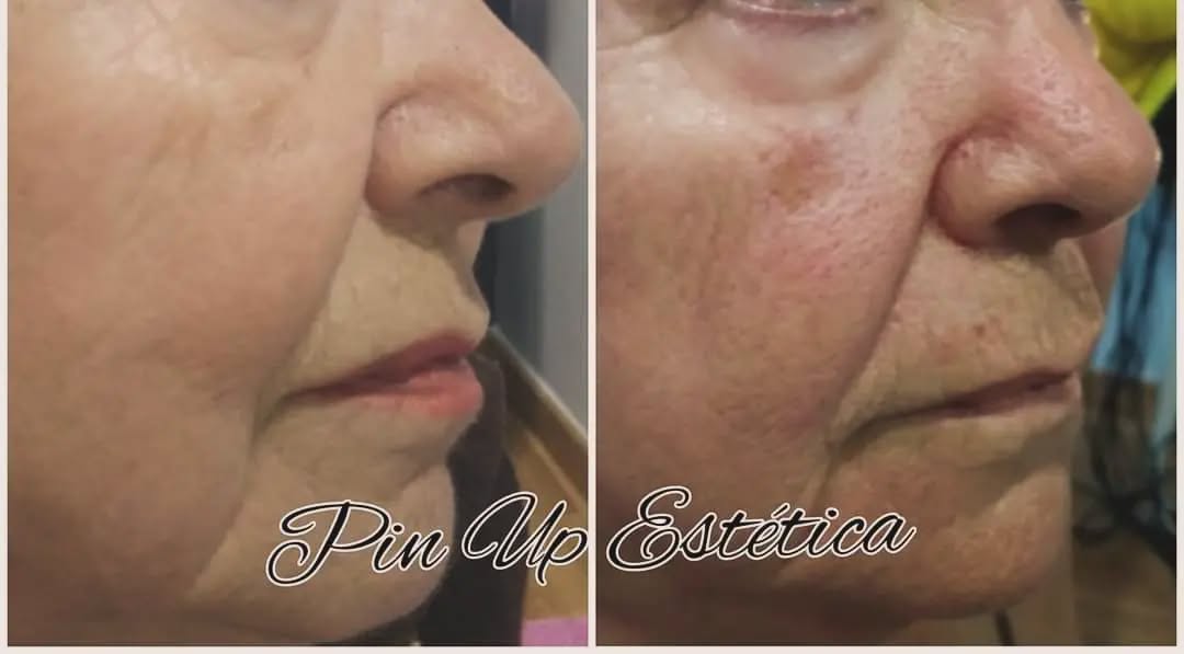 Fotorejuvenecimiento
#rejuvenescimentofacial
#fotorejuvenecimientofacial
#esteticaavanzada
#estética
#esteticaaguadulce
#tratamientofacial
#dermapen
#dermalift
#hialuronico
#exosomas
pin Up estética
Avd. Carlos III N 216
Aguadulce Almería