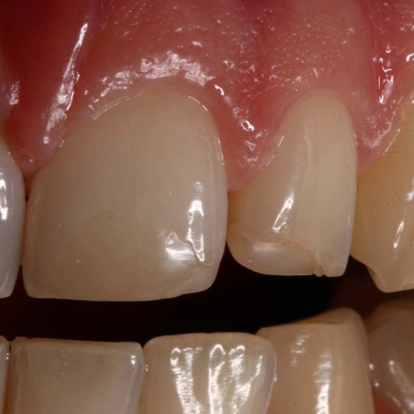 Recambio de restauraciones de resina antiguas.
En este paciente realizamos el retiro de 2 resinas antiguas de color defectuoso, bordes fracturados y diferentes grados de infiltración, por nuevas restauraciones que devuelven el color y la forma, integrándose de forma funcional y estética a la estructura dentaria.