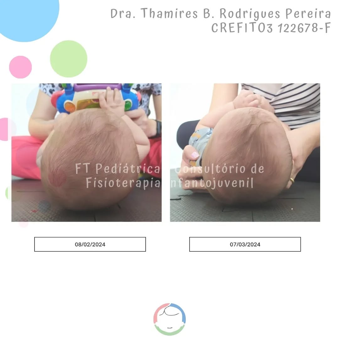 4 sessões separam esse antes e depois... Sessões de manuseios gentis, sem alongamento, sem manipulação do crânio... Sessões regadas a muito respeito pelo tempo do bebê... Sessões embasadas em fisiologia, anatomia e biomecânica...
Ainda temos um caminho para percorrer... Mas já temos um bebê com autonomia sobre seu corpo e uma família mais tranquila...
Seguimos!
Método de Setti - em formação
@carolinadesetti