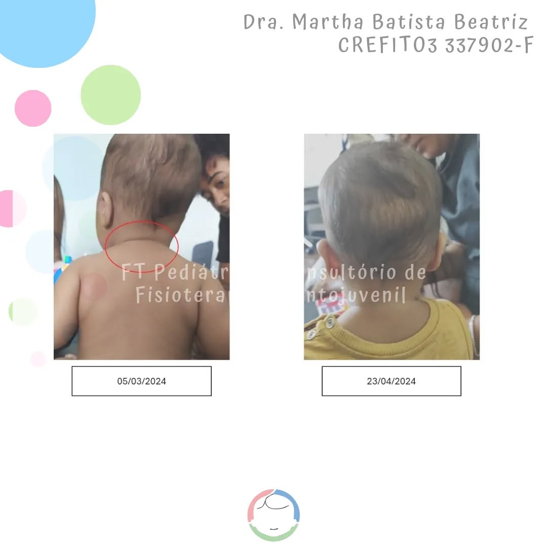 Mais um bebê dando tchau para o Torcicolo e para o Atraso no Desenvolvimento Motor...