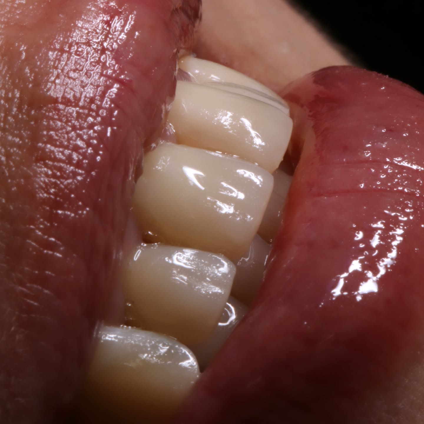 DISEÑO DE SONRISA CON RESINA COMPUESTA
En esta paciente realizamos 4 Carillas Directas de Resina, con planificación digital, para minimizar el desgaste y devolver estructura dentaria perdida, mejorando estetica y función.