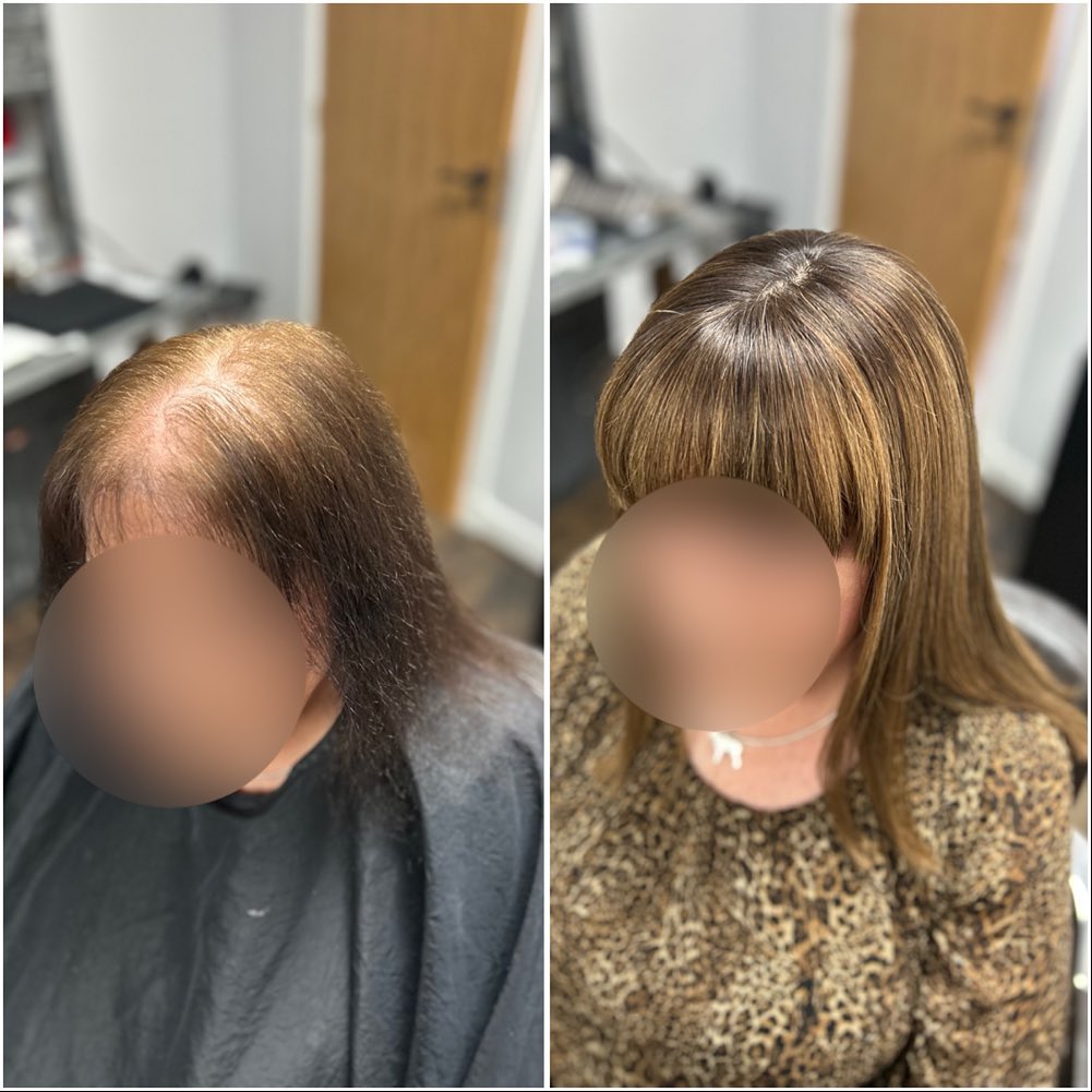 It was a pleasure getting to know this lovely lady today ❤️. After a lot of thought she decided to take the plunge and get in touch.
I look forward to seeing her again in 5 weeks for her maintenance appointment.
.
.
.
.
.
.
#lacetopwigs #lacefrontwigs #lacewigs #wigs #lacefrontal #alopecia #areata #hairloss #hairreplacements #bespokewigs #customcolouredwigs #handmadewigs #wigbuilding #hairintegration #laceintegration #hairextensions #weave #hairlossspecialist #trichologist #trichology #hairlosssolution #hairlosssalon #hair #femalepatternbaldness #female #femalehairloss #hairideas