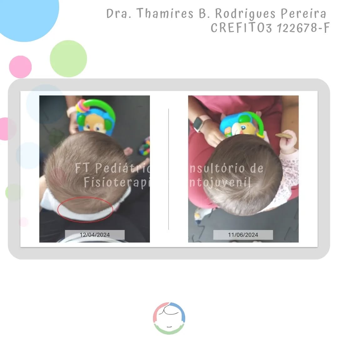 Resultados em dose dupla!
Gemelar 2
Início do tratamento Fisioterapeuta @thamiresbrodrigues e @martha_bbeatriz dando continuidade.
Método De Setti - em formação
@carolinadesetti