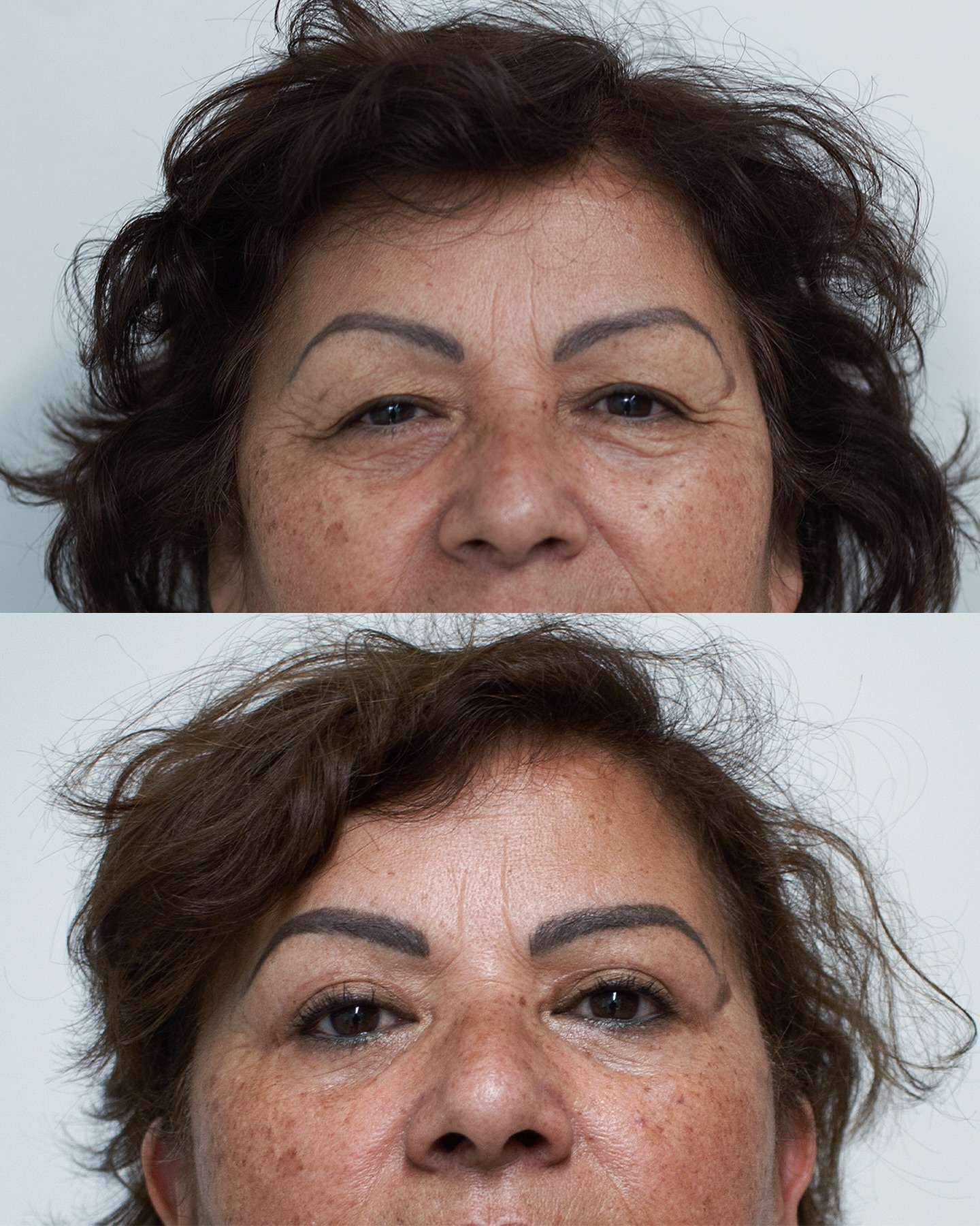 Queremos mostrarle este hermoso resultado de una blefaroplastia superior e inferior con 3 meses de evolución 💞 Increíble procedimiento para rejuvenecer la mirada ¿Qué les pareció?