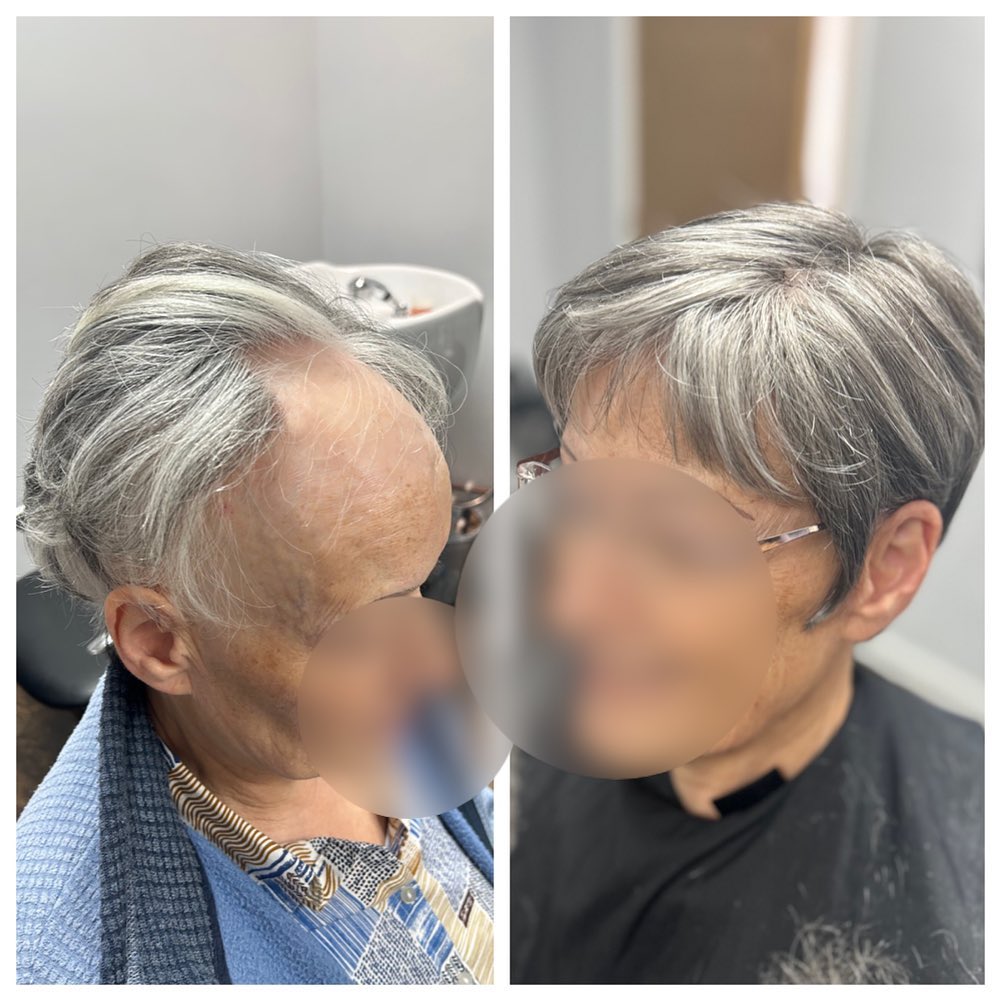 Before & After
This lovely lady came to visit me a few weeks ago. She has Frontal Fibrosing Alopecia, a type of scarring alopecia, and now was finding it difficult to cover up as it’s reaching advanced stages.
Today I fitted her with a hair piece that she can wear with confidence ❤️.
.
.
.
.
.
#lacetopwigs #lacefrontwigs #lacewigs #wigs #lacefrontal #alopecia #areata #hairloss #hairreplacements #bespokewigs #customcolouredwigs #handmadewigs #wigbuilding #hairintegration #laceintegration #hairextensions #weave #hairlossspecialist #trichologist #trichology #hairlosssolution #hairlosssalon #hair #frontalfibrosingalopecia #ffa #scarringalopecia