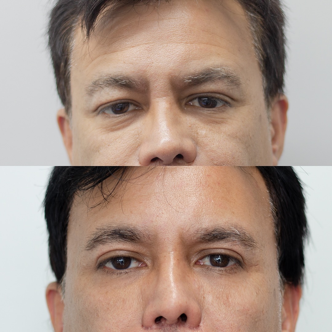 Rejuvenece tu mirada 👀
Este paciente se realizó una blefaroplastia superior con cantopexia! Obtenemos un resultado muy natural y sin cicatrices visibles!