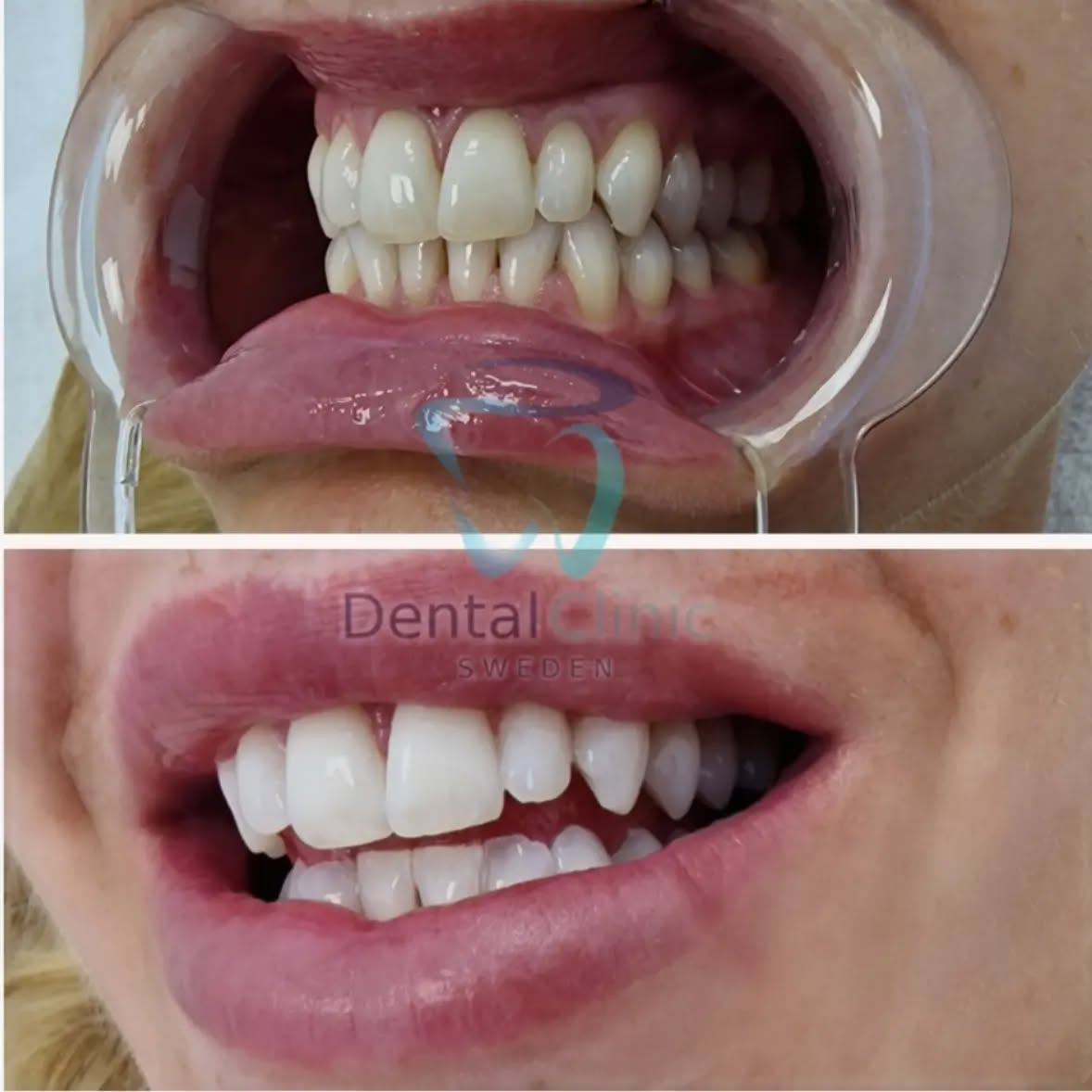 Klinik Tandblekning 
ERBJUDANDE 995 KR (Ordinarie pris 4900 kr)
ONLINE TIDSBOKNING
www.DentalClinicSweden.org🔺️
 #tandblekningstockholm #TandblekningStockholm #tandblekning #tandsmycke #tandsmyckestockholm #stockholm #liljeholmen #KlinikTandblekning #TandblekningGöteborg #TandblekningUppsala #TandblekningUtbildning #fillers #fillersstockholm #fillersgöteborg #fillersmalmö #TandblekningsUtbildning #fillersstockholm #russianlipsstockholm