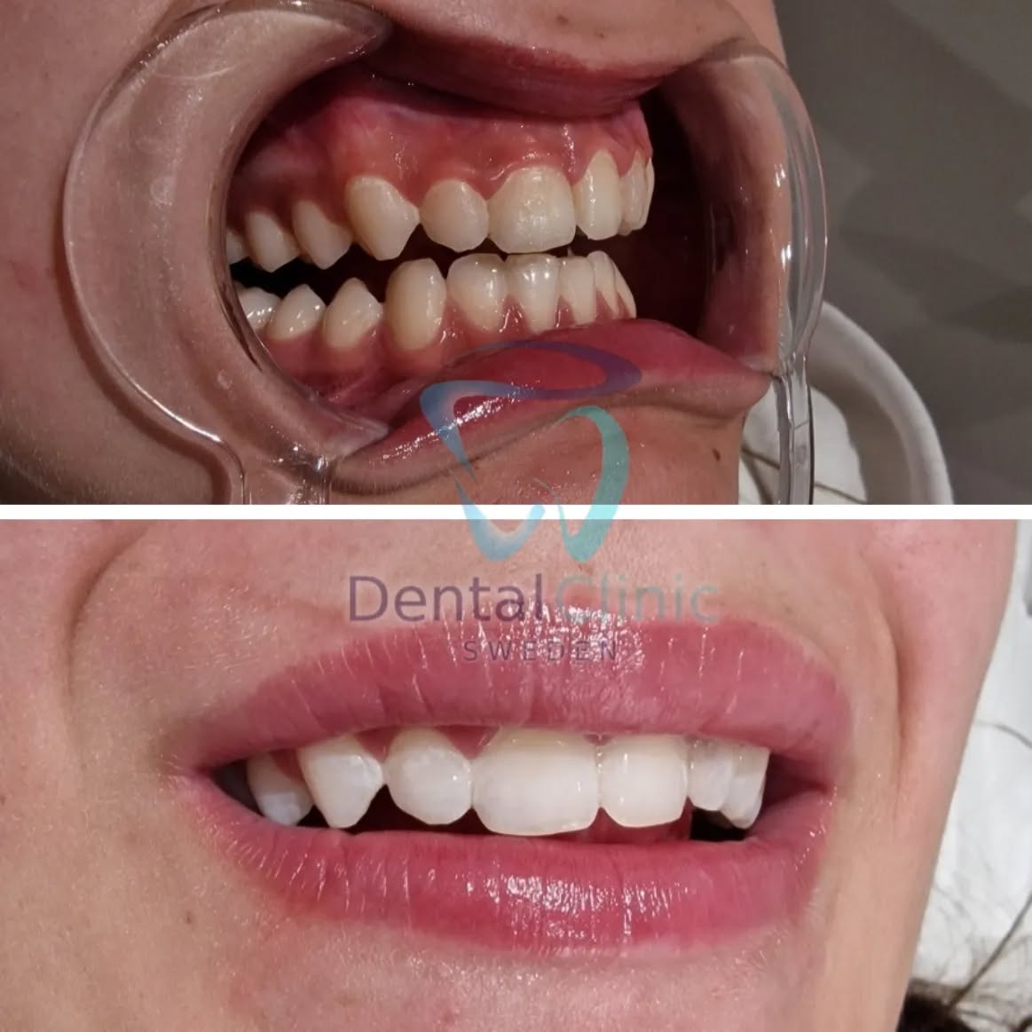 Klinik Tandblekning 
ERBJUDANDE 995 KR (Ordinarie pris 4900 kr)
ONLINE TIDSBOKNING
www.DentalClinicSweden.org🔺️
 #tandblekningstockholm #TandblekningStockholm #tandblekning #tandsmycke #tandsmyckestockholm #stockholm #liljeholmen #KlinikTandblekning #TandblekningGöteborg #TandblekningUppsala #TandblekningUtbildning #fillers #fillersstockholm #fillersgöteborg #fillersmalmö #TandblekningsUtbildning #fillersstockholm #russianlipsstockholm