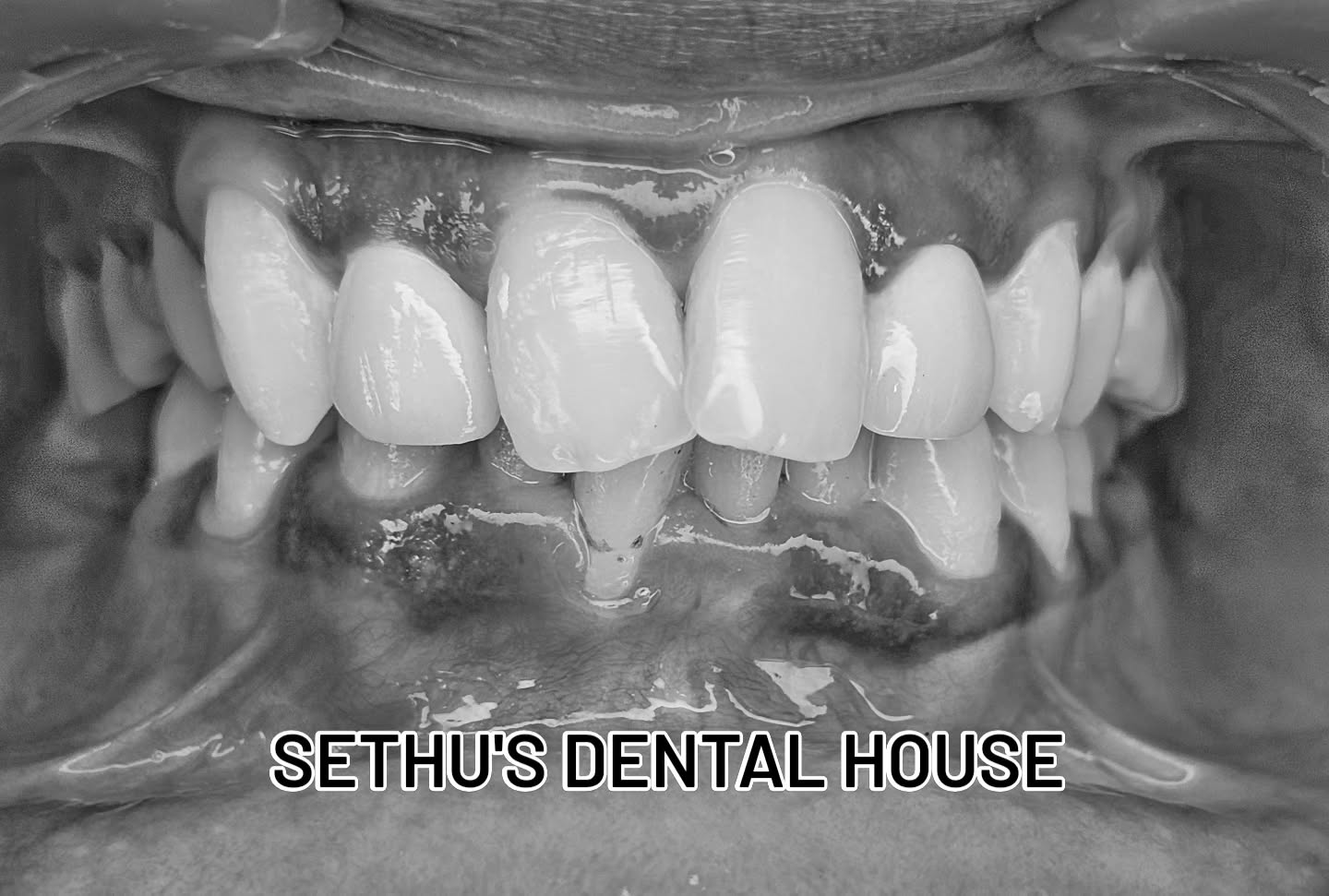 Can you identify the abutment and the crown material? Post your answers in the comments. The answers will be revealed after 24 hours.