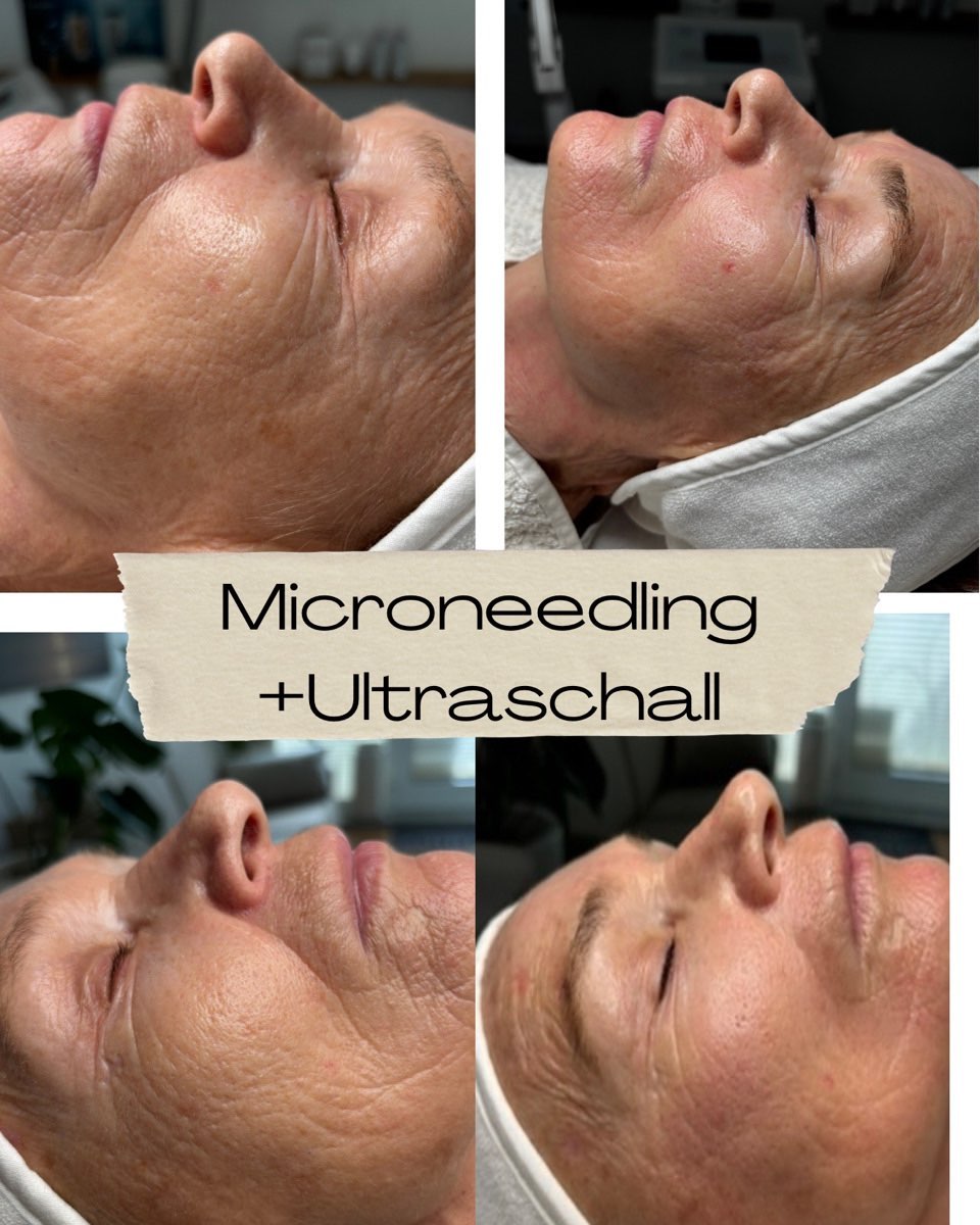 Sofort Effekt nach eine Behandlung Microneedling + Ultraschall #microneedling#ultraschalll#antiaging#krefeld#iontosono#megaeffekt