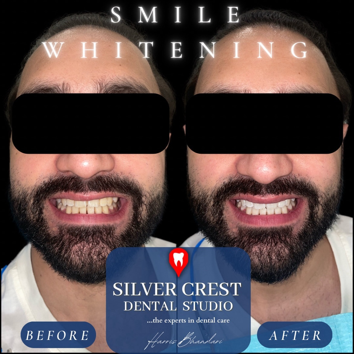 Just something as minimal as a simple Teeth Whitening has the potential to elevate your smile to a whole new level! 🦷😬
Indulge in our bespoke Teeth Whitening Packages to know more! DM “Brighten my Smile” for offers and special discounts.
#teethwhitening #brightersmile #smiledesign #smilemakeover #beyou #whitening #bleaching #teethbleaching #zoomwhitening #brightening #smilesformiles