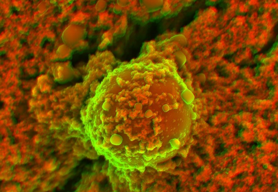 Cardiac calcification
#science #electronmicroscope #laboratory #scienceart #sciencephoto #scientific #scienceweek #research #lab #micro #microscope #microscopy #medicine #medicalsciencestudent #medicalstudent #macrophotography #mineralomics #bio #biology #bioimaging #biologylab #minerals #chemistry #material #engineering #physics #sciencecommunication #ucl #DDCSEM #Mineralomics