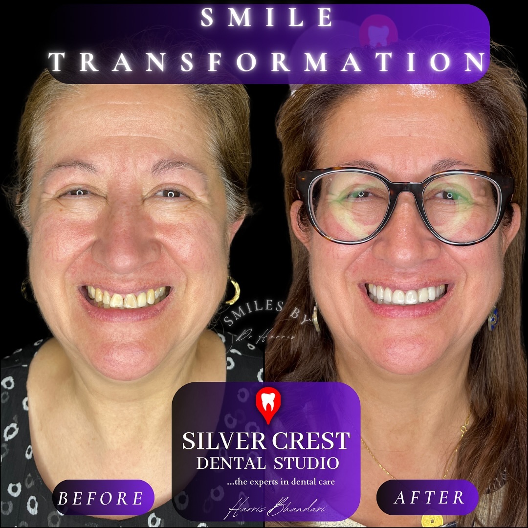 “Journey of a lifetime”
A stellar smile makeover for beautiful Adrianna, who flew in happy and flew out happier! ✈️✈️
This makeover includes a full workover with Veneers, Crowns AND Implants, working in harmony to achieve a balanced and beautiful smile! 🦷😬
#smilemakeover #smiledesign #smile #cosmeticdentistry #cosmeticdentist #aesthetics #dentalimplant #porcelainveneers #dentalveneers #crowns #dentalcrown #dentistindelhi #aestheticstyle