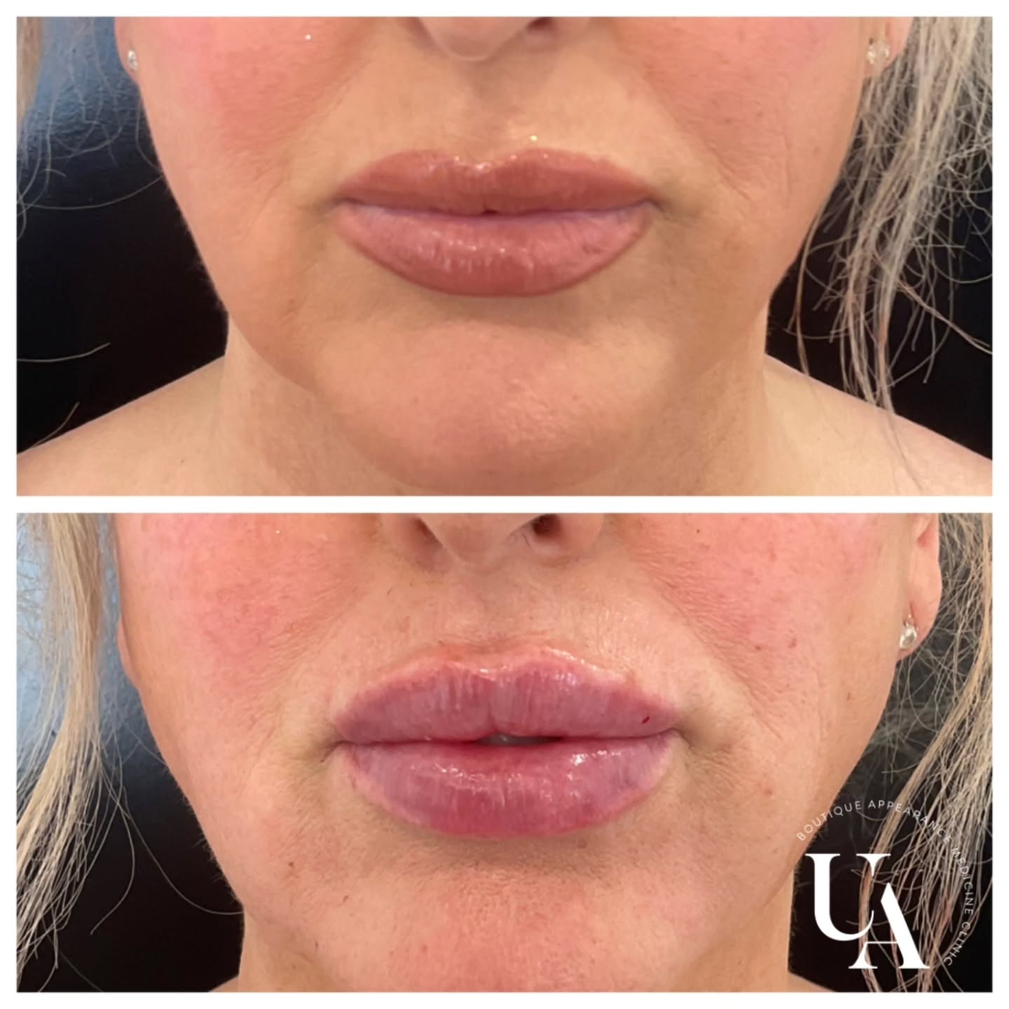Another busy Lippie day! ❤️
1ml of premium filler was used on my lovely lady❤️
Some swelling is present and will settle over the next couple of weeks.
LOVE my job❤️
Happy weekend lovelies!
*Individual results may vary*
Dermal filler injections are Medical devices for the treatment of loss of volume in the skin. Dermal fillers have risks and benefits. Ask your doctor if dermal filler injections are is right for you. For further information ask your doctor or go to www.medsafe.govt.nz
#lipsbyrachel #lipskapiti #lipswellington #cosmeticinjectables #kapiticosmeticclinic #lippies
