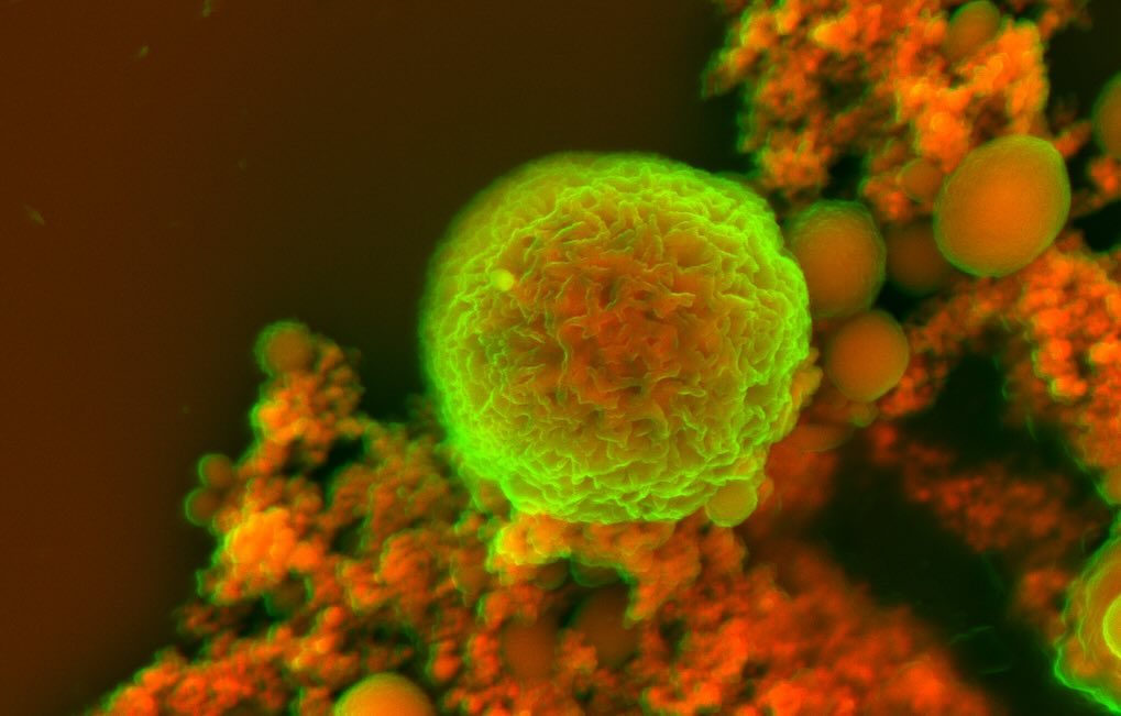 Cardiac calcification
#science #electronmicroscope #laboratory #scienceart #sciencephoto #scientific #scienceweek #research #lab #micro #microscope #microscopy #medicine #medicalsciencestudent #medicalstudent #macrophotography #mineralomics #bio #biology #bioimaging #biologylab #minerals #chemistry #material #engineering #physics #sciencecommunication #ucl #DDCSEM #Mineralomics