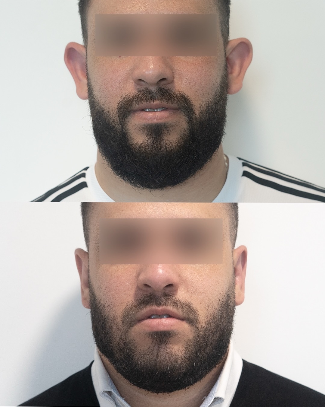 💉Otoplastia + Lobuloplastia
⏰ 25 días de evolución
En este caso no solo podemos observar un increíble cambio con tan solo 25 días pero también podemos ver en qué zonas tendremos las suturas, las cuales se retiran aproximadamente al mes.