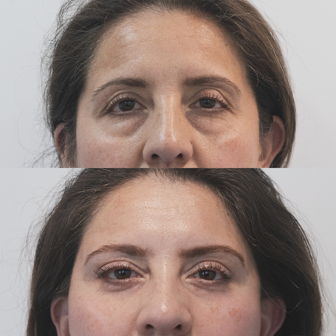 Esta paciente se realizó una blefaroplastia de 4 párpados y un fox eye, podemos observar como su mirada rejuveneció ✨