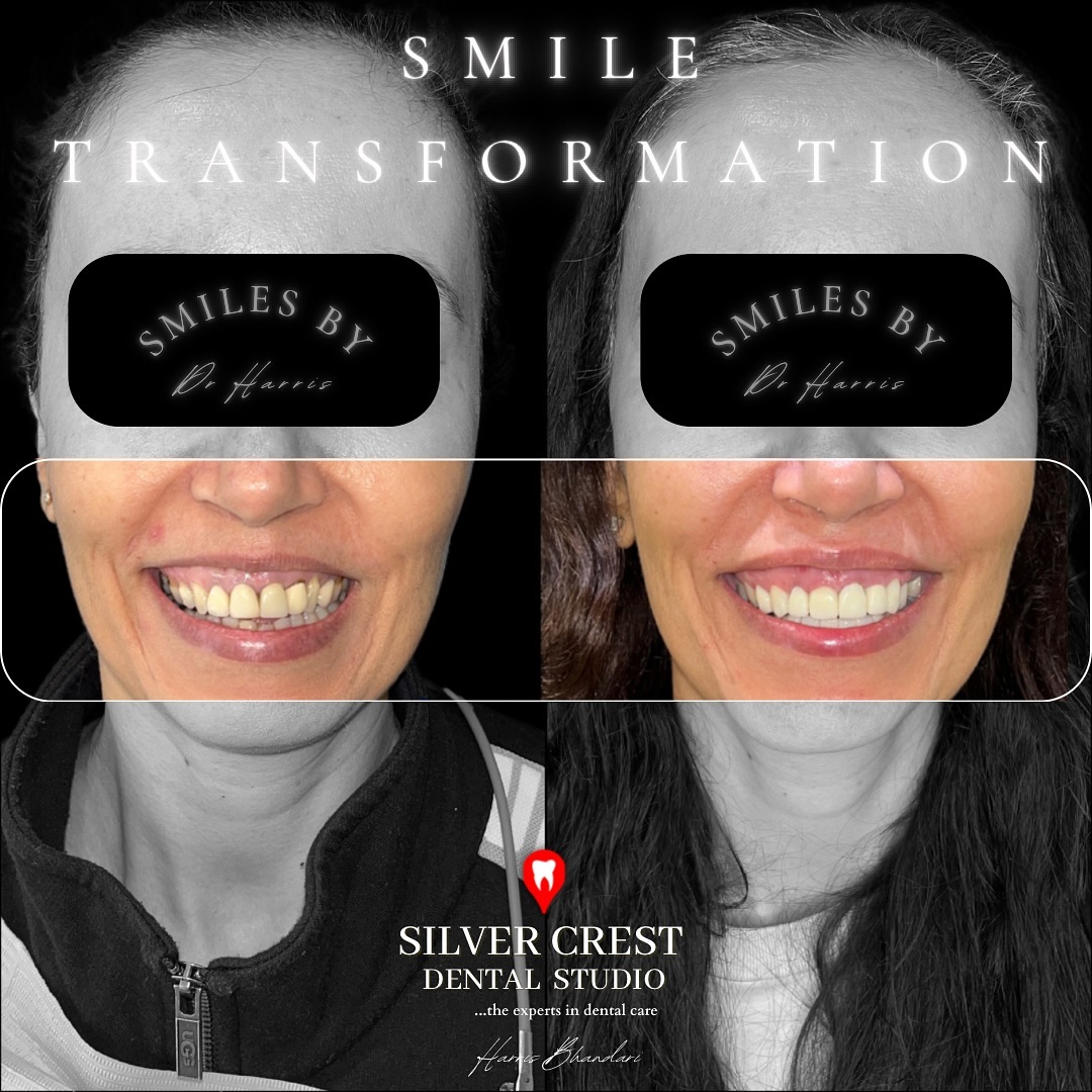 Subtle yet striking - a comprehensive smile transformation combining the best of gum surgery, ceramic veneers/crowns and minor surgical lip repositioning to achieve stable and amazing results for our beautiful patient from Washington 🇺🇸
#smiledesign #smilemore #veneers #cosmeticdentistry #aestheticdentistry #fyp #smiletransformation #porcelainveneers #ceramicveneers #dentalcrowns #implants #dentalimplants