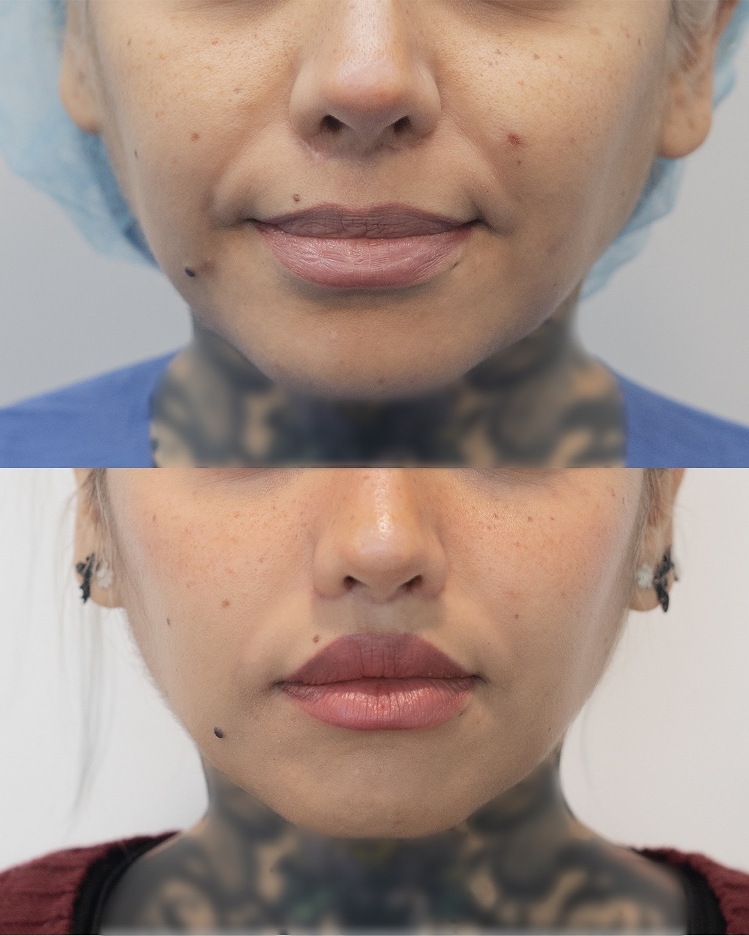 💉Upper lip Lift
⏰ 3 meses
Está paciente vino a nosotros a realizarse un segundo Upper lip lift ya que el primero fue realizado por otro doctor pero no obtuvo los resultados deseados!