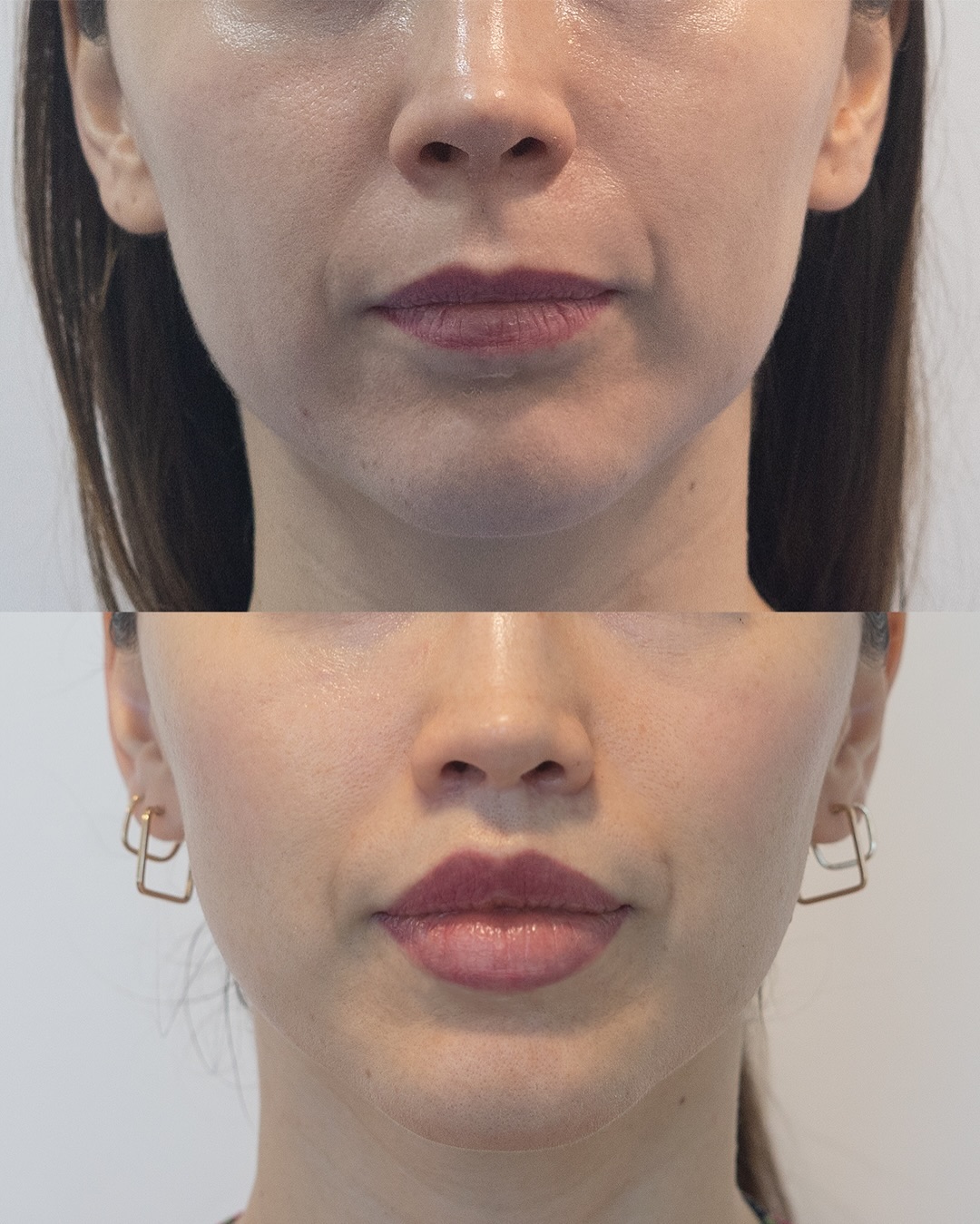 Queremos mostrarles este espectacular caso de una paciente que se realizó Upper lip lift y Down lip lift! Estás cirugías son para aumentar el tamaño de los labios de forma permanente sin rellenos ni necesidad de retoques