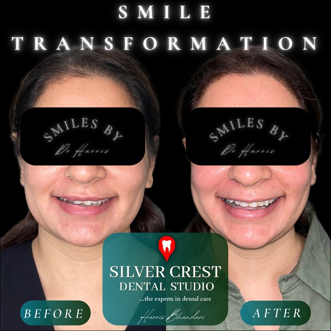 •Subtle changes go a long way•
A little bit of composite edge bonding is a very minimalistic way to ensure a confident smile! DM us to know more 🦷
#dentist #composite #veneers #smiledesign #digitaldentistry #teethwhitening #cosmeticdentistry #aestheticdentistry