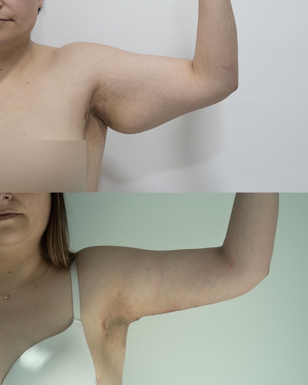 En este caso queremos mostrarles este hermoso resultado de un lifting de brazos, en este caso también realizamos una lipoescultura de la zona del brazo y de la axila. Qué tal les parece este resultado?