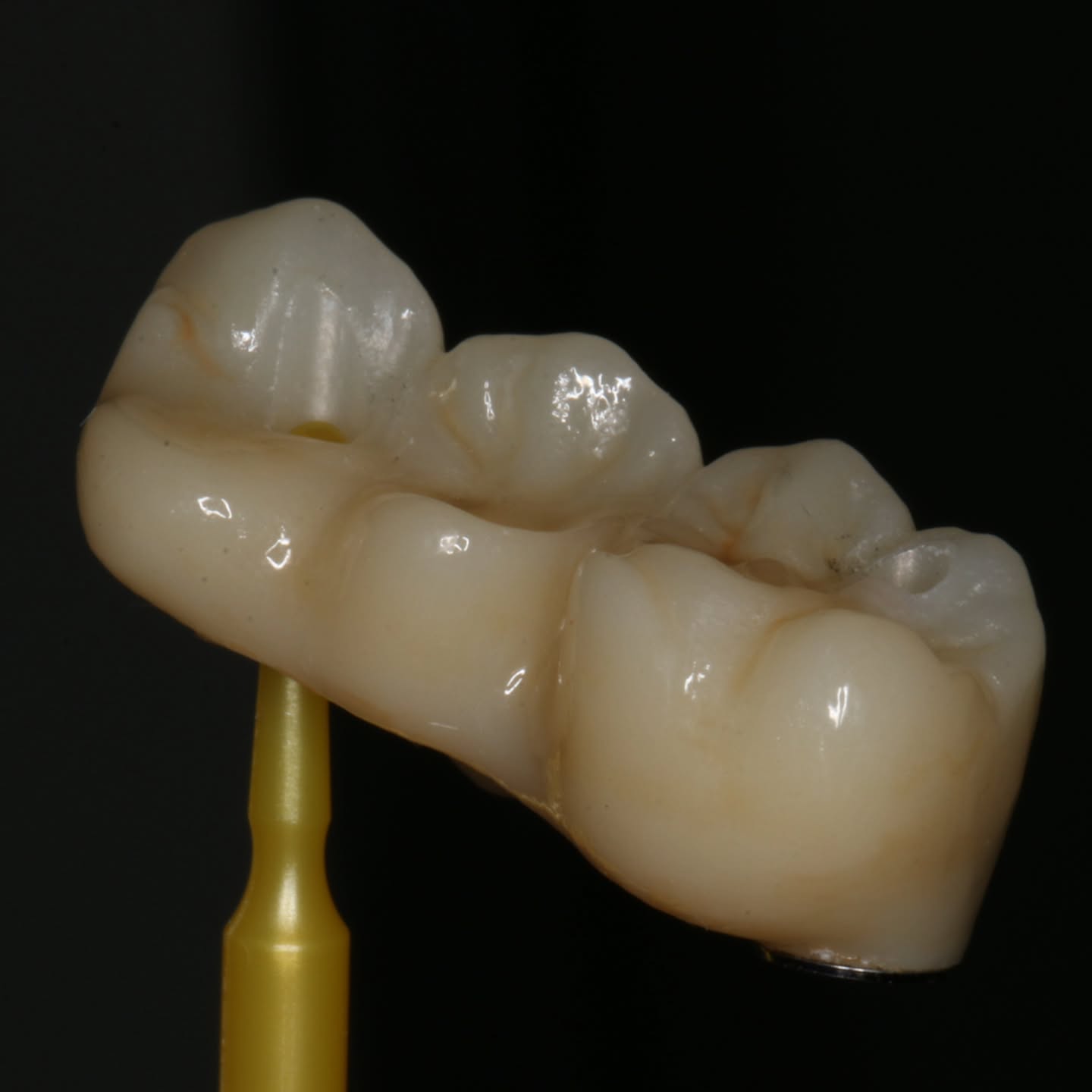Puente de Zirconio, atornillado sobre 2 implantes.
Una forma cómoda e higiénica de devolver dientes perdidos, restaurando la función y mejorando la estética.