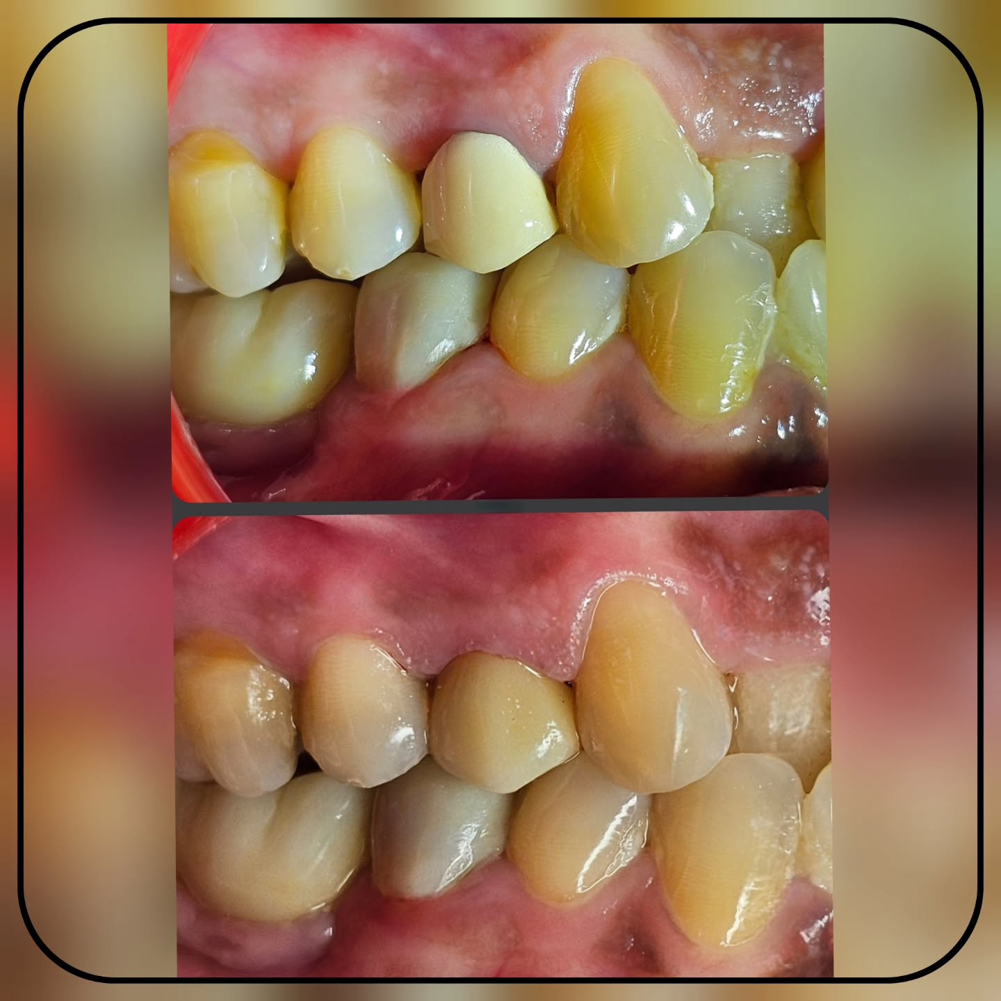 All Prosthodontists are dentists but not all dentists are prosthodontists!!
The outcome of a crowns depends on both the clinician and the lab technician factors.
The grayscale image highlights how opaque and translucent crowns showcase themselves. The opaque surfaces reflect the light and appear more bright whereas the translucent surfaces allow light to pass through mimics the natural tooth surface .
Precise, Pleasant and Aesthetic Dentistry By Dr. Sethuraman Ramadoss MDS, Prosthodontist and Implantologist.
For dental queries contact
Sethu's Dental House
9789247362
Also do comment the remaining crowns that you can identify in this picture.
#Zirconia #translucent #biomimeticdentistry #biomimicry